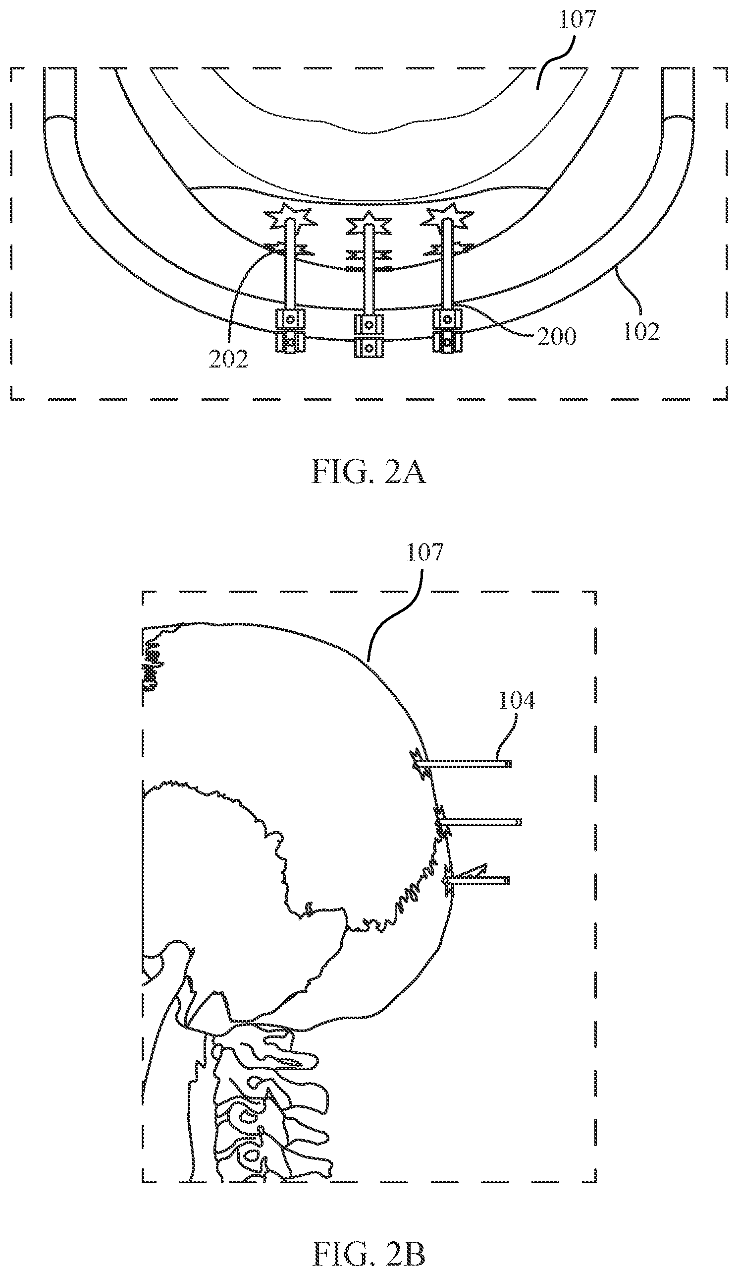 Patent US12472035 Figure 2 – Orthopedic device for midfacial bone structure advancement