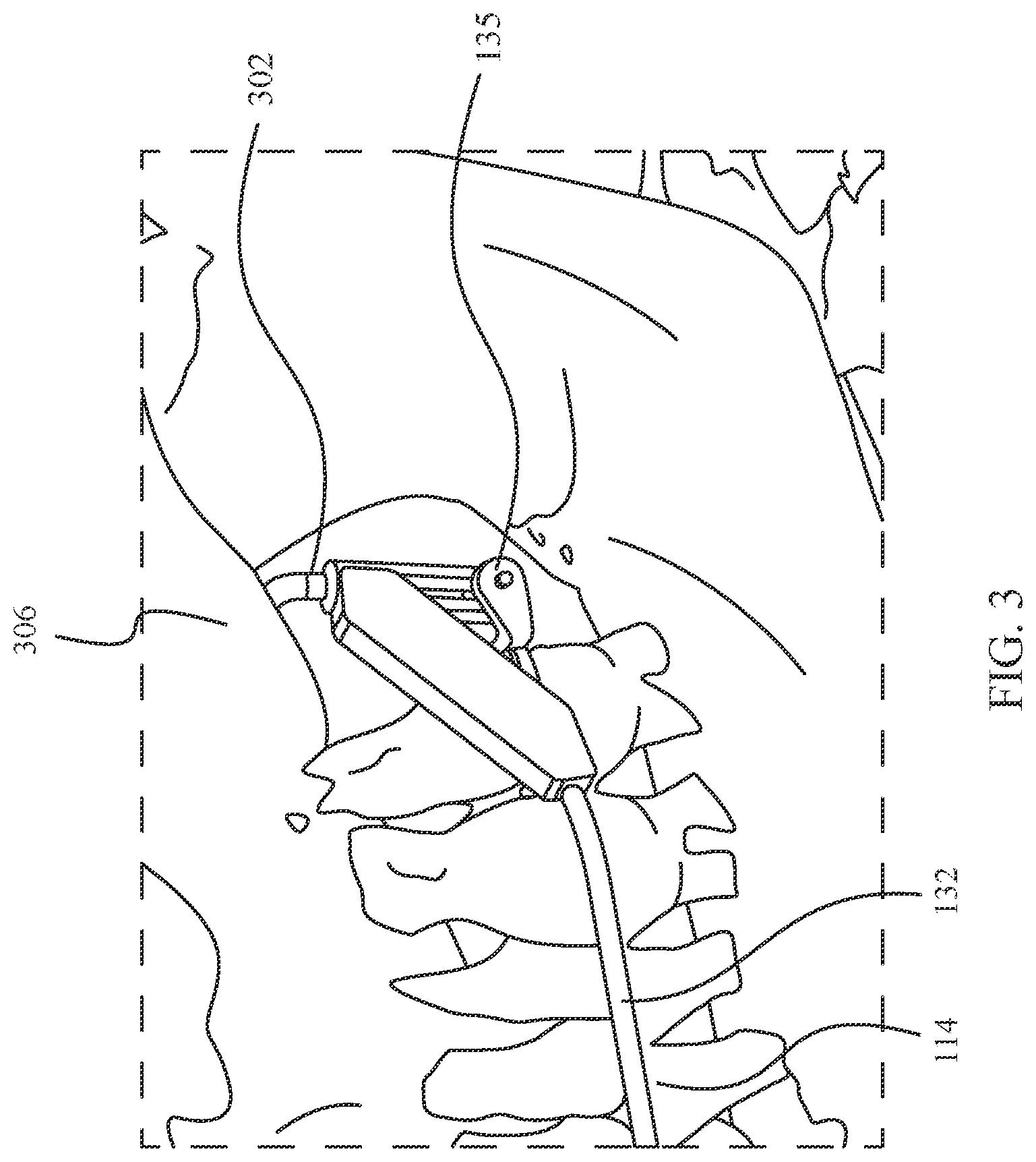 Patent US12472035 Figure 3 – Orthopedic device for midfacial bone structure advancement