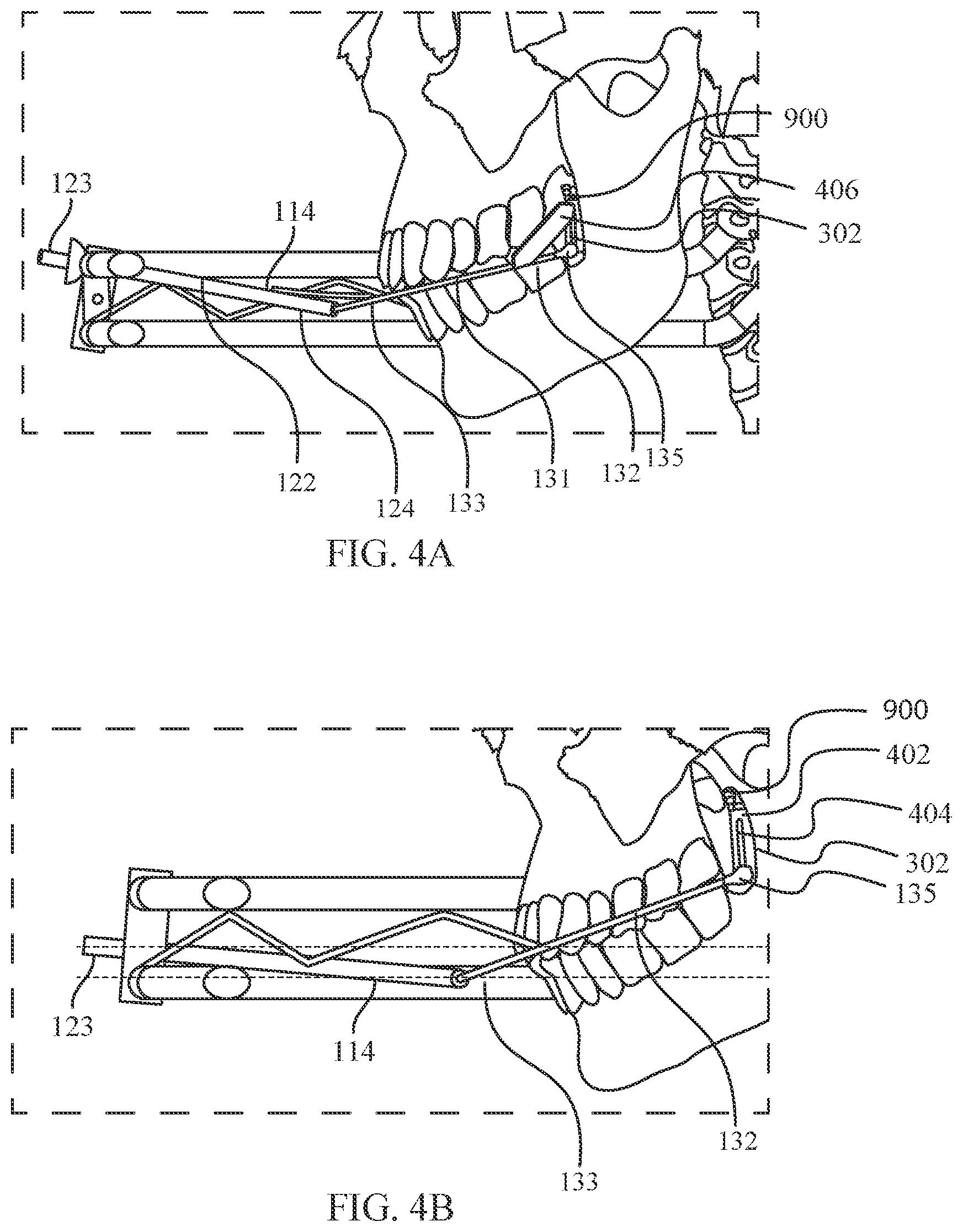 Patent US12472035 Figure 4 – Orthopedic device for midfacial bone structure advancement
