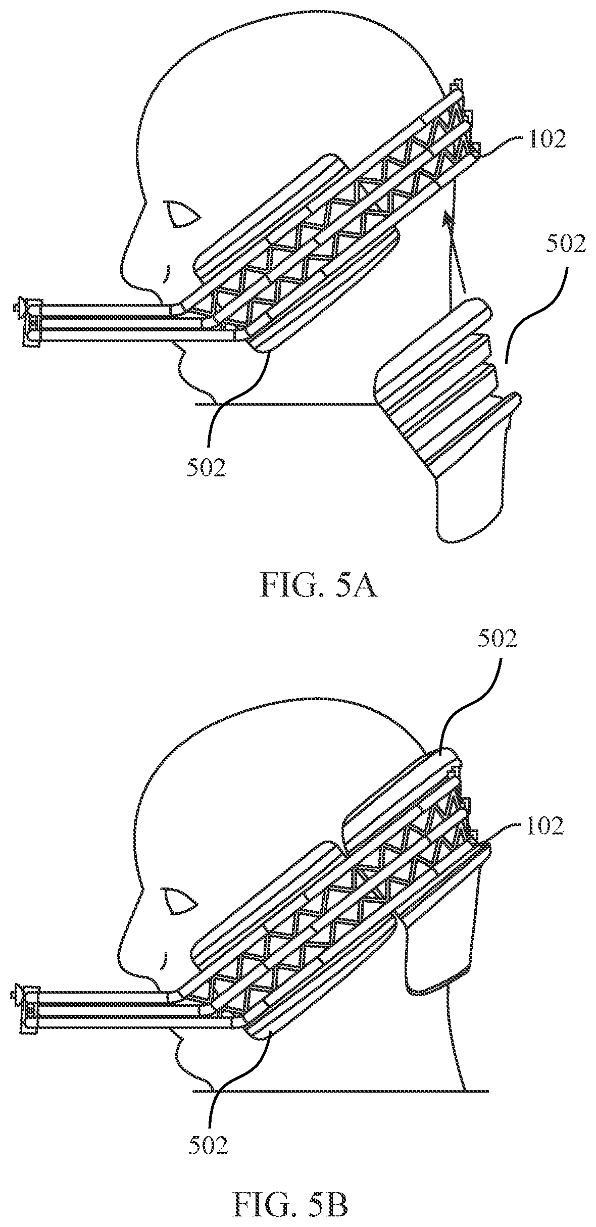 Patent US12472035 Figure 5 – Orthopedic device for midfacial bone structure advancement