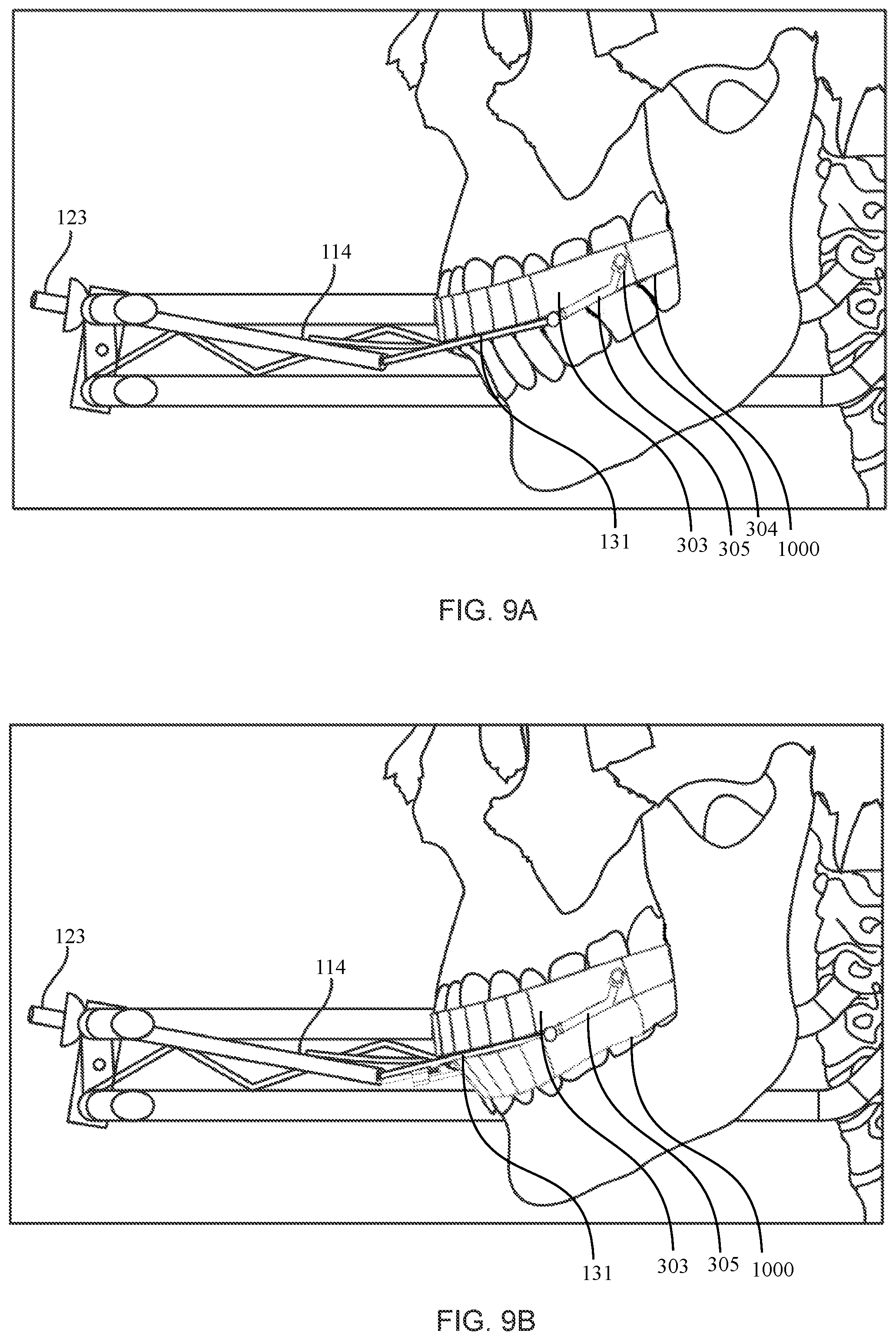 Patent US12472035 Figure 9 – Orthopedic device for midfacial bone structure advancement