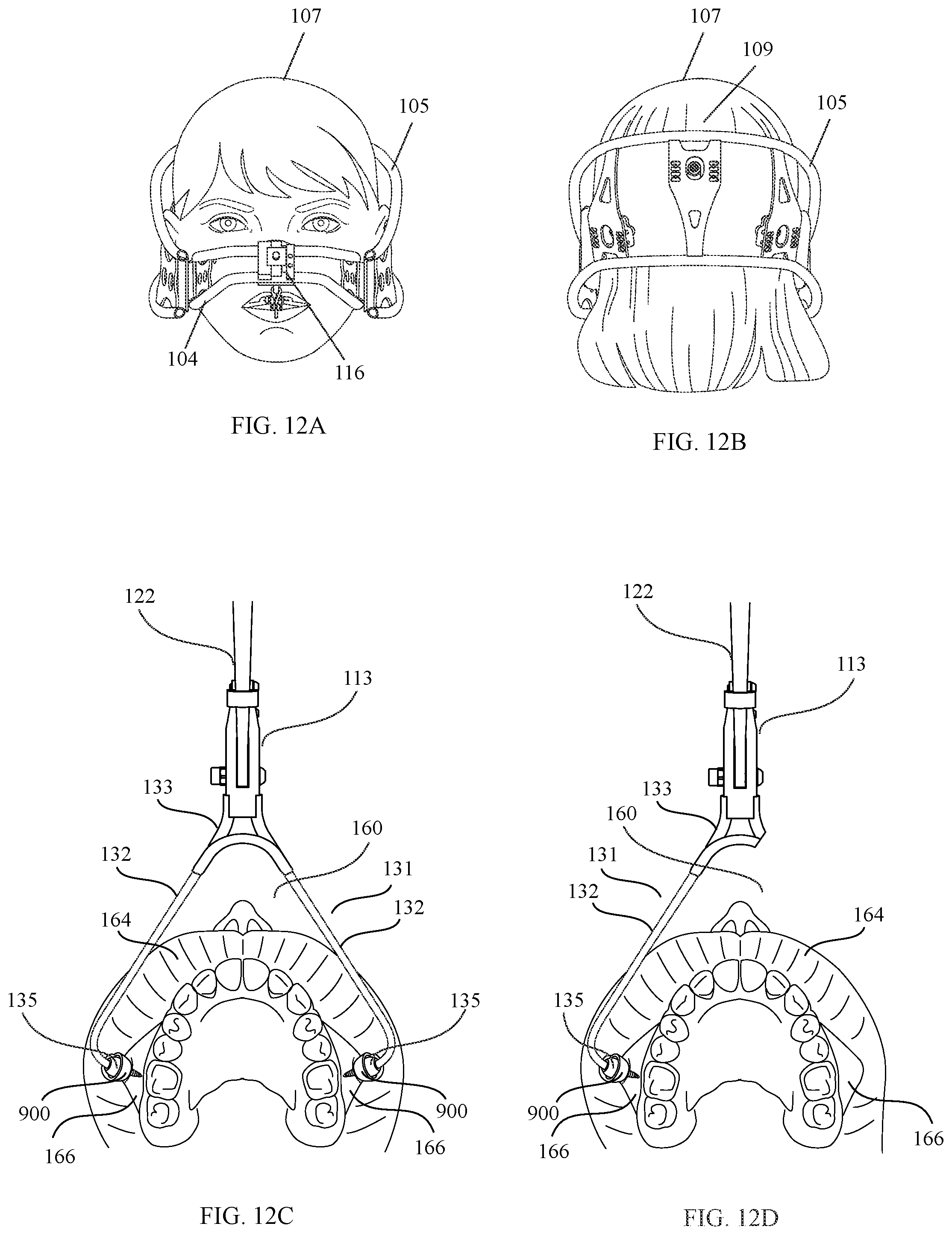 Patent US12472035 Figure 12 – Orthopedic device for midfacial bone structure advancement