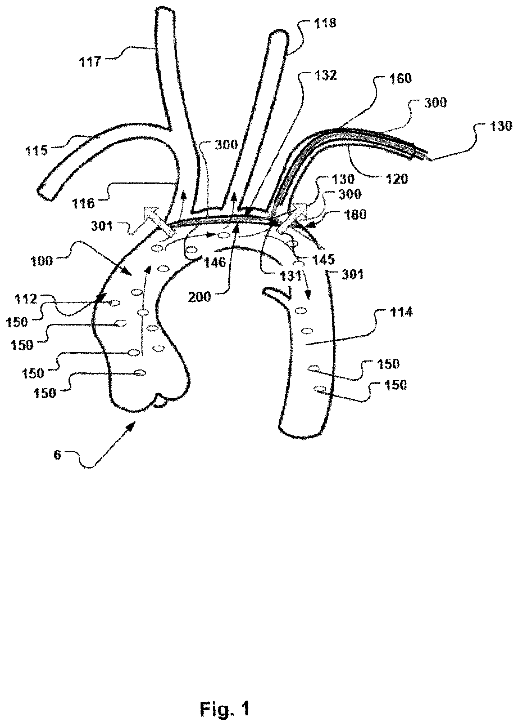 Patent US12472051 Figure 1 – Embolic protection device and method