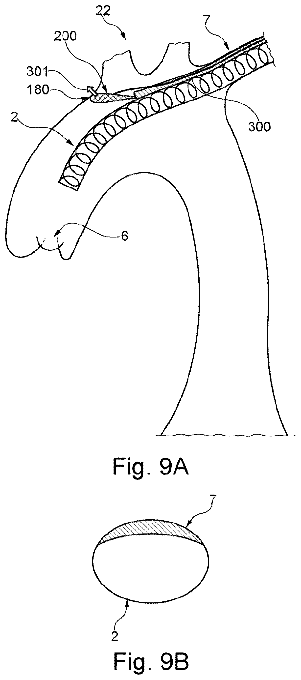 Patent US12472051 Figure 5 – Embolic protection device and method