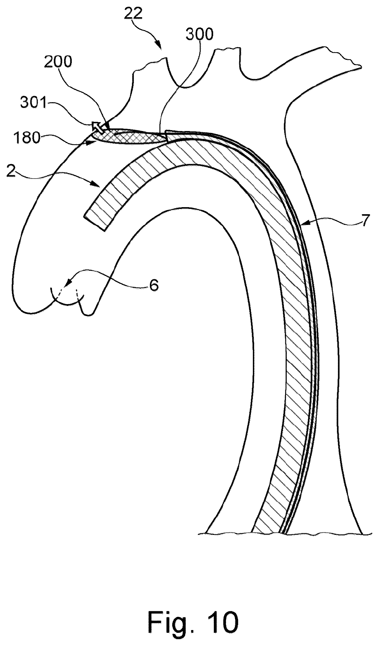 Patent US12472051 Figure 6 – Embolic protection device and method