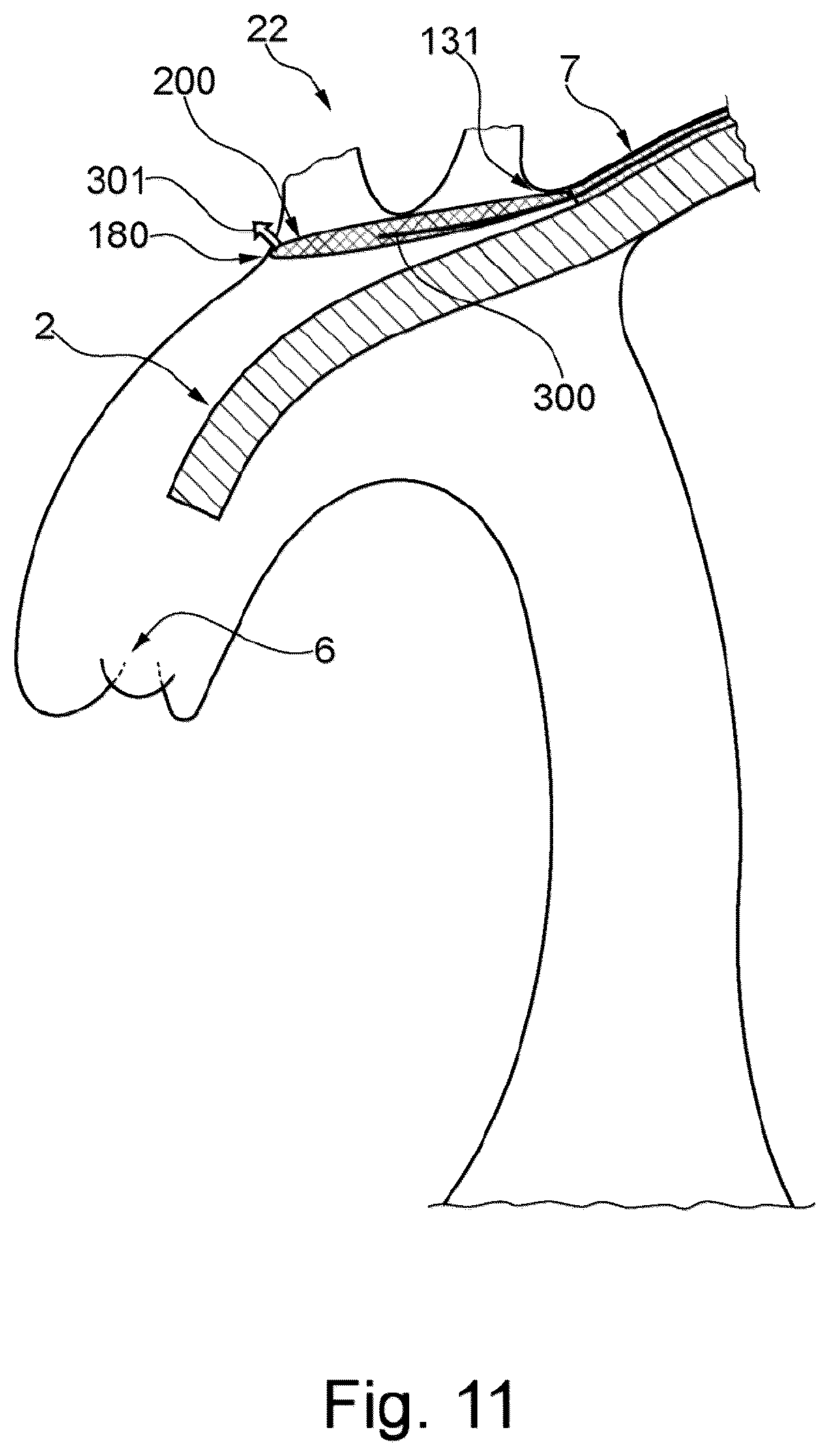 Patent US12472051 Figure 7 – Embolic protection device and method
