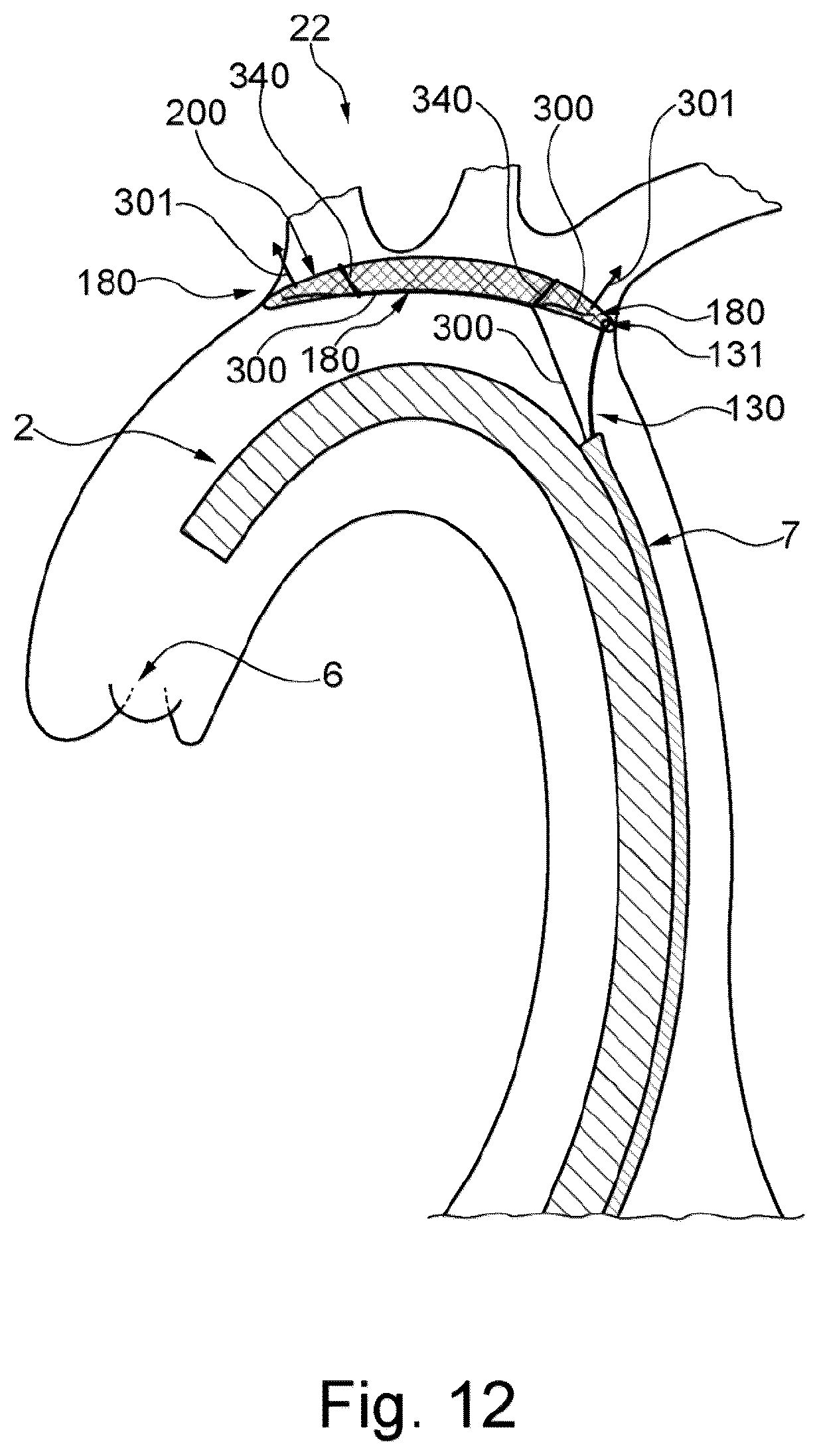 Patent US12472051 Figure 8 – Embolic protection device and method