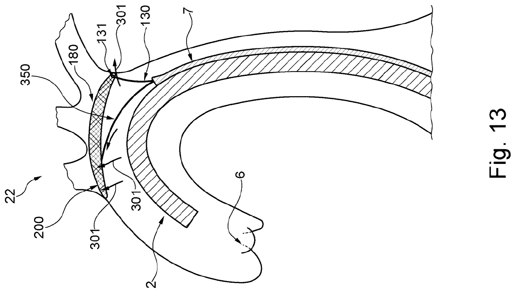 Patent US12472051 Figure 9 – Embolic protection device and method