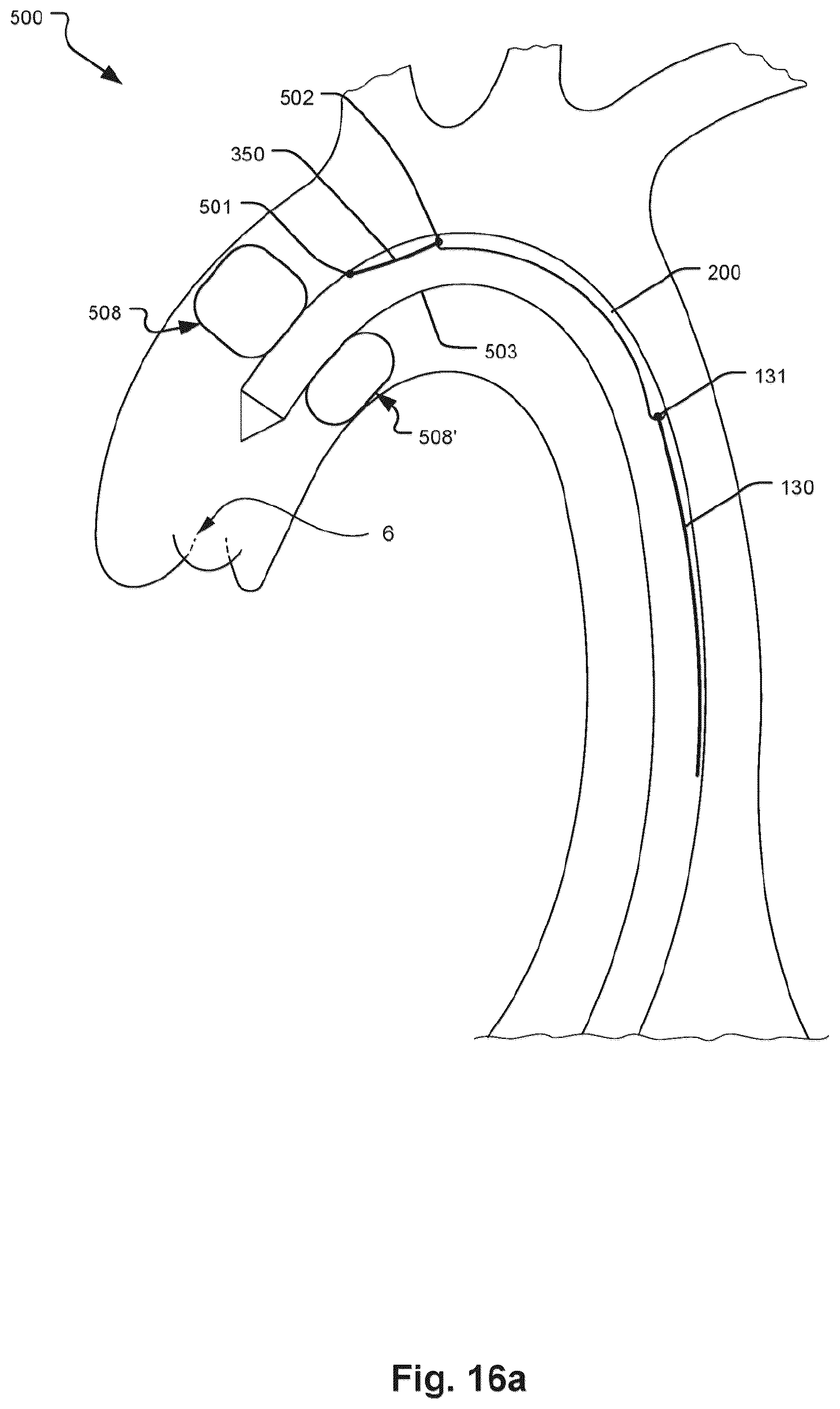 Patent US12472051 Figure 11 – Embolic protection device and method