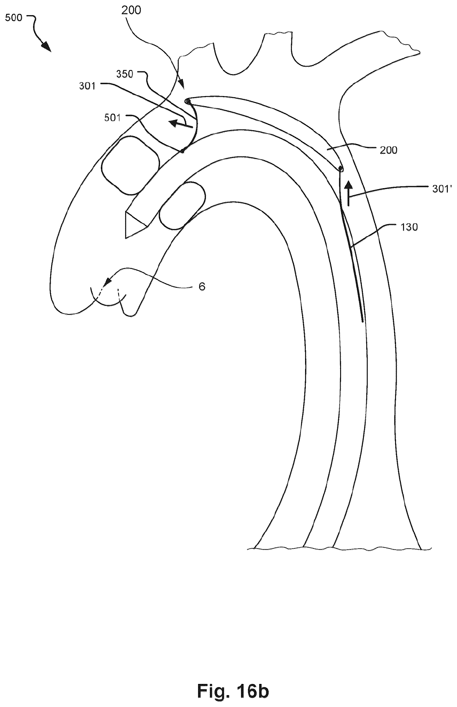Patent US12472051 Figure 12 – Embolic protection device and method