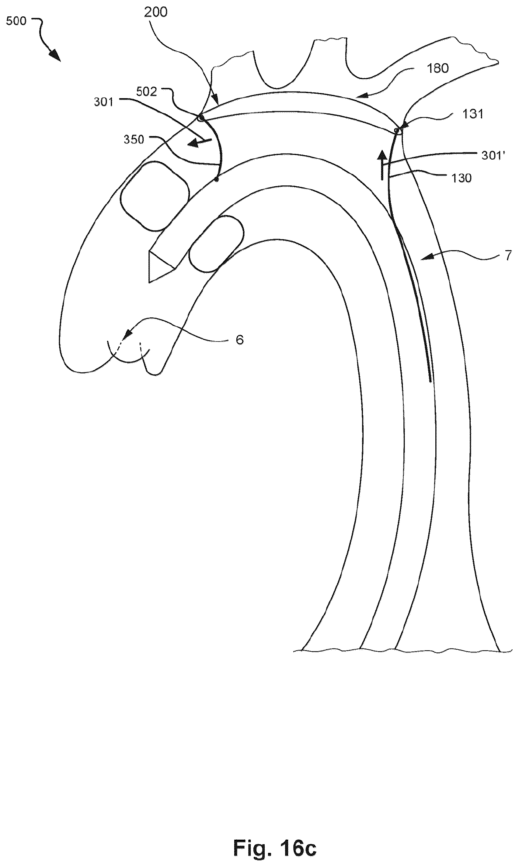 Patent US12472051 Figure 13 – Embolic protection device and method