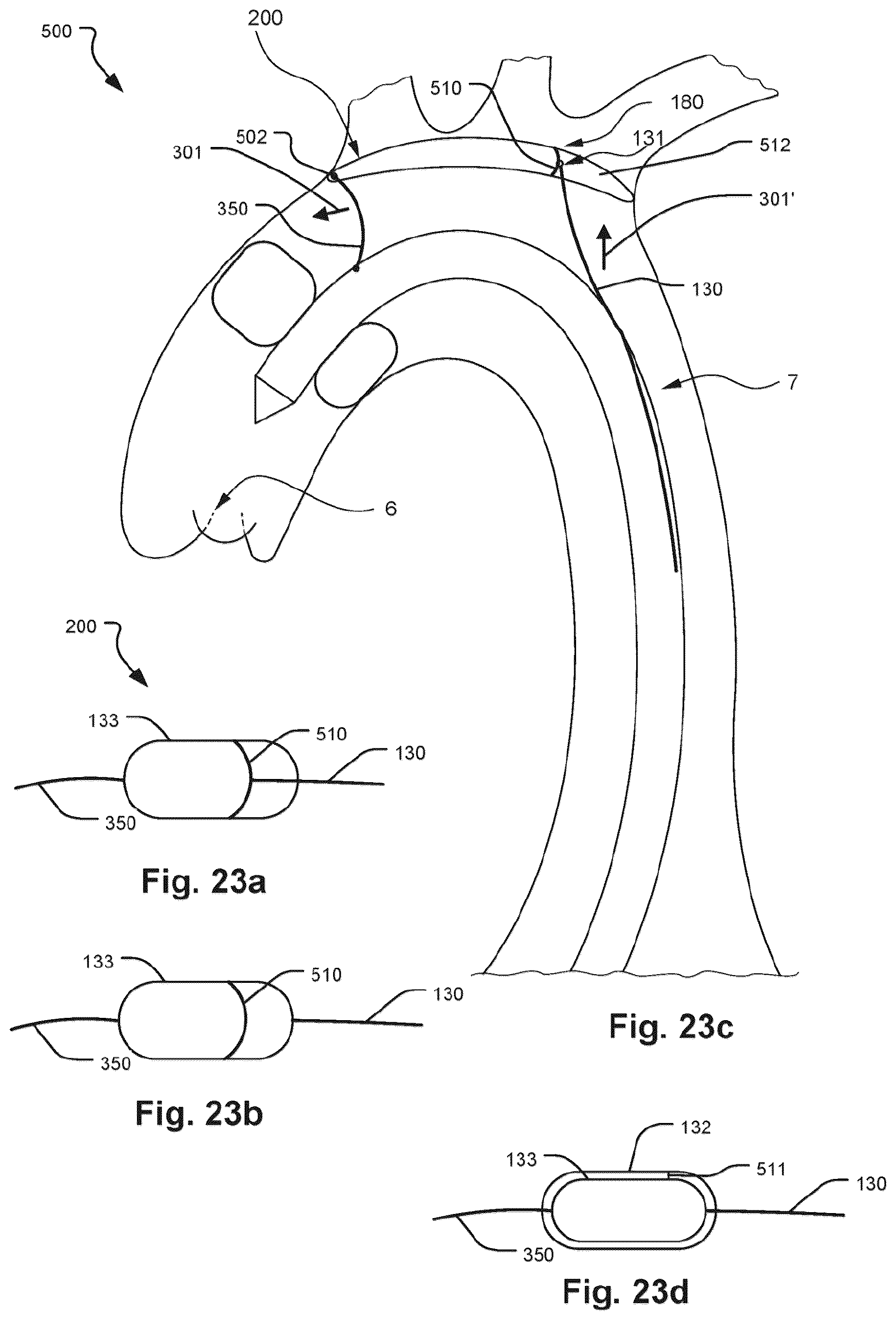 Patent US12472051 Figure 20 – Embolic protection device and method