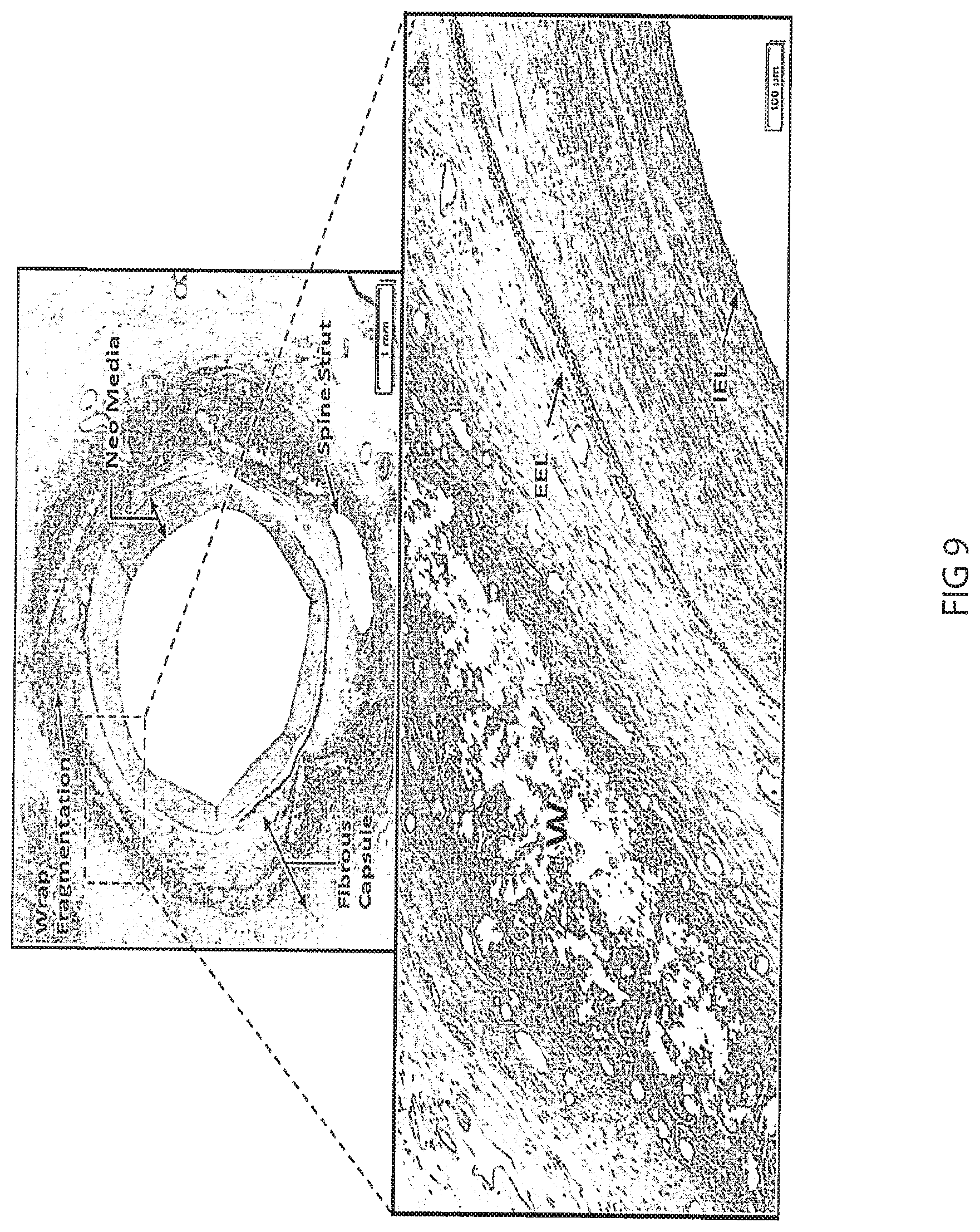 Patent US12472053 Figure 12 – Multiple layer vascular graft