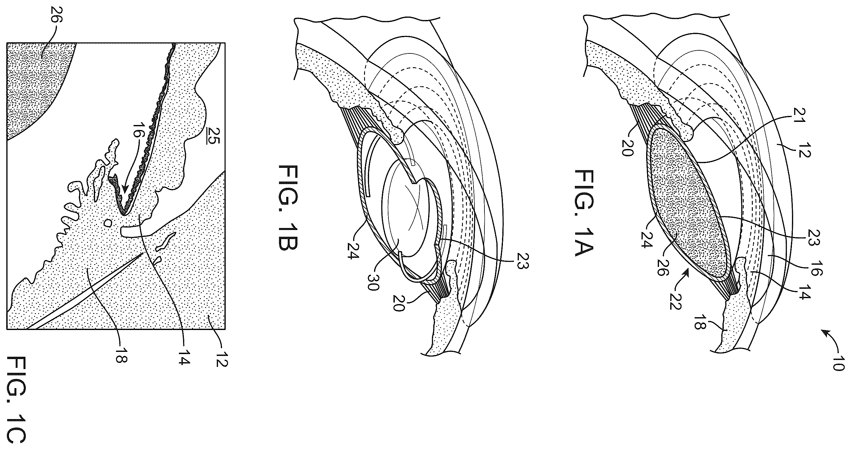 Patent US12472055 — Accommodating intraocular lens and methods of implantation — Figure 1