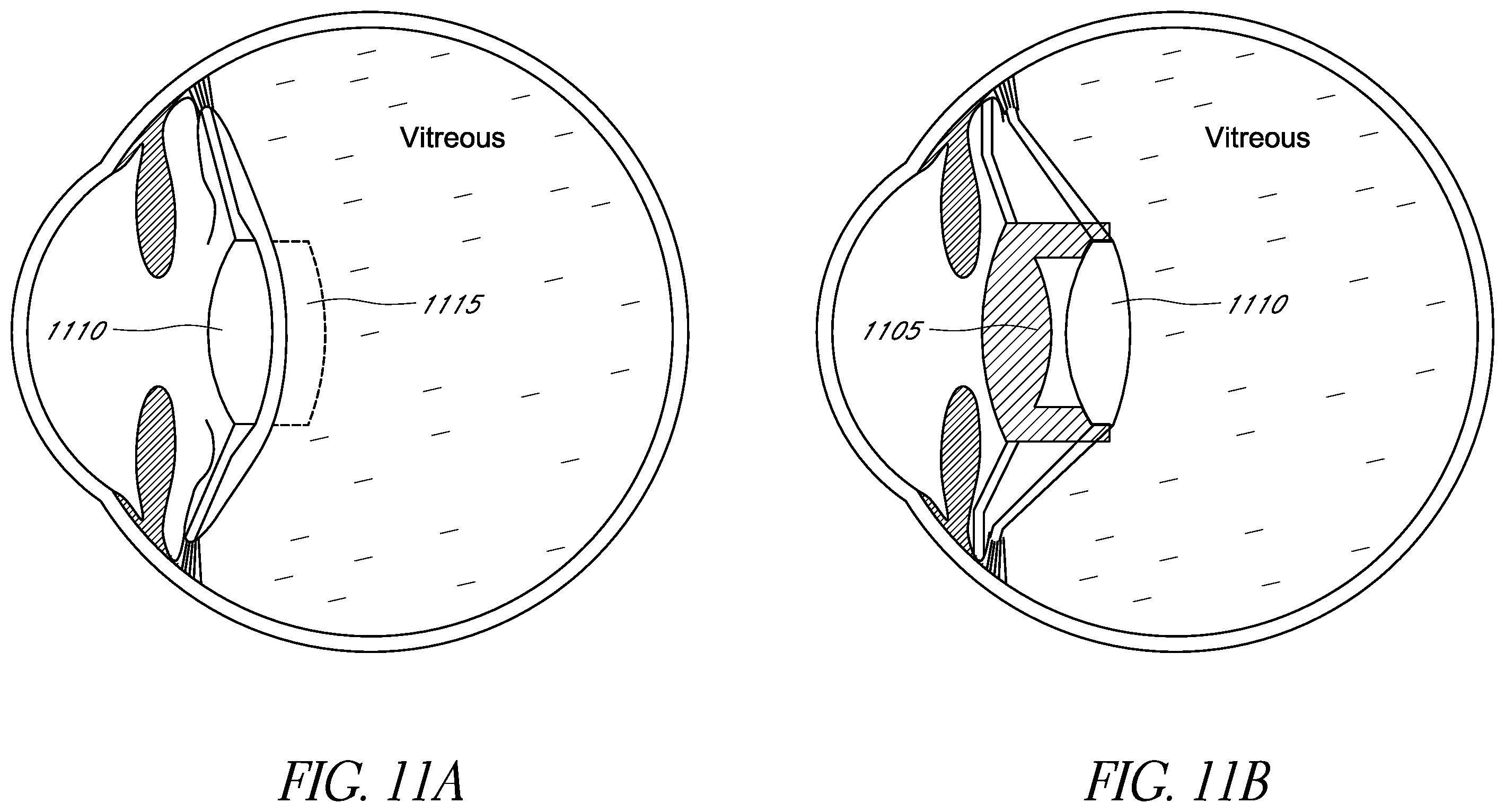Patent US12472056 Figure 16 – Ophthalmic devices, system and methods that improve peripheral vision