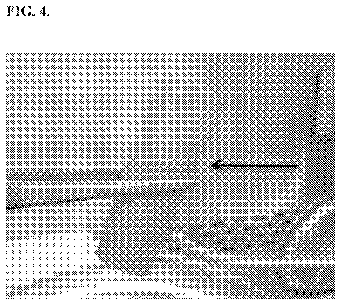 Patent US12472057 Figure 4 – Tubular prostheses