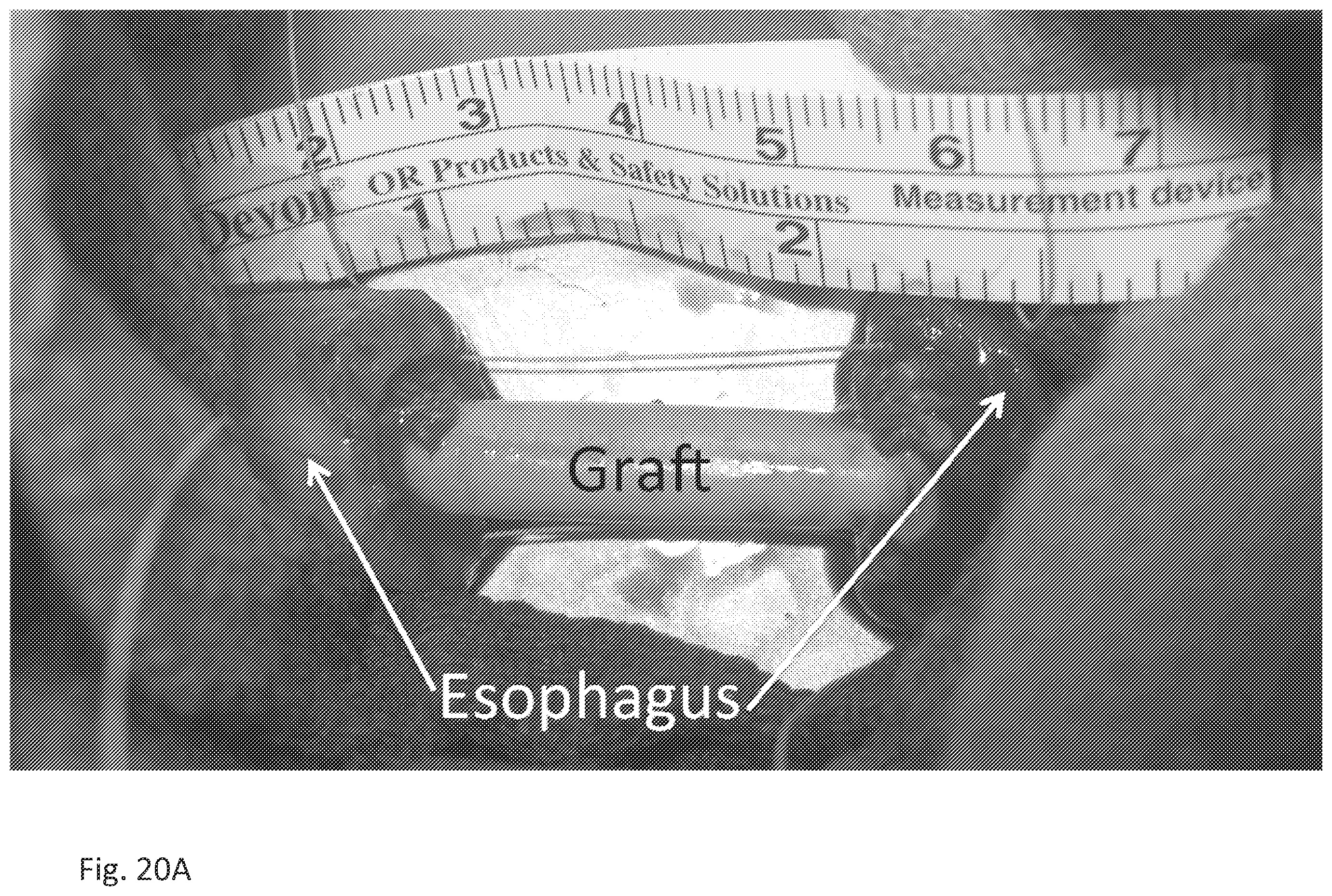 Patent US12472057 Figure 20 – Tubular prostheses