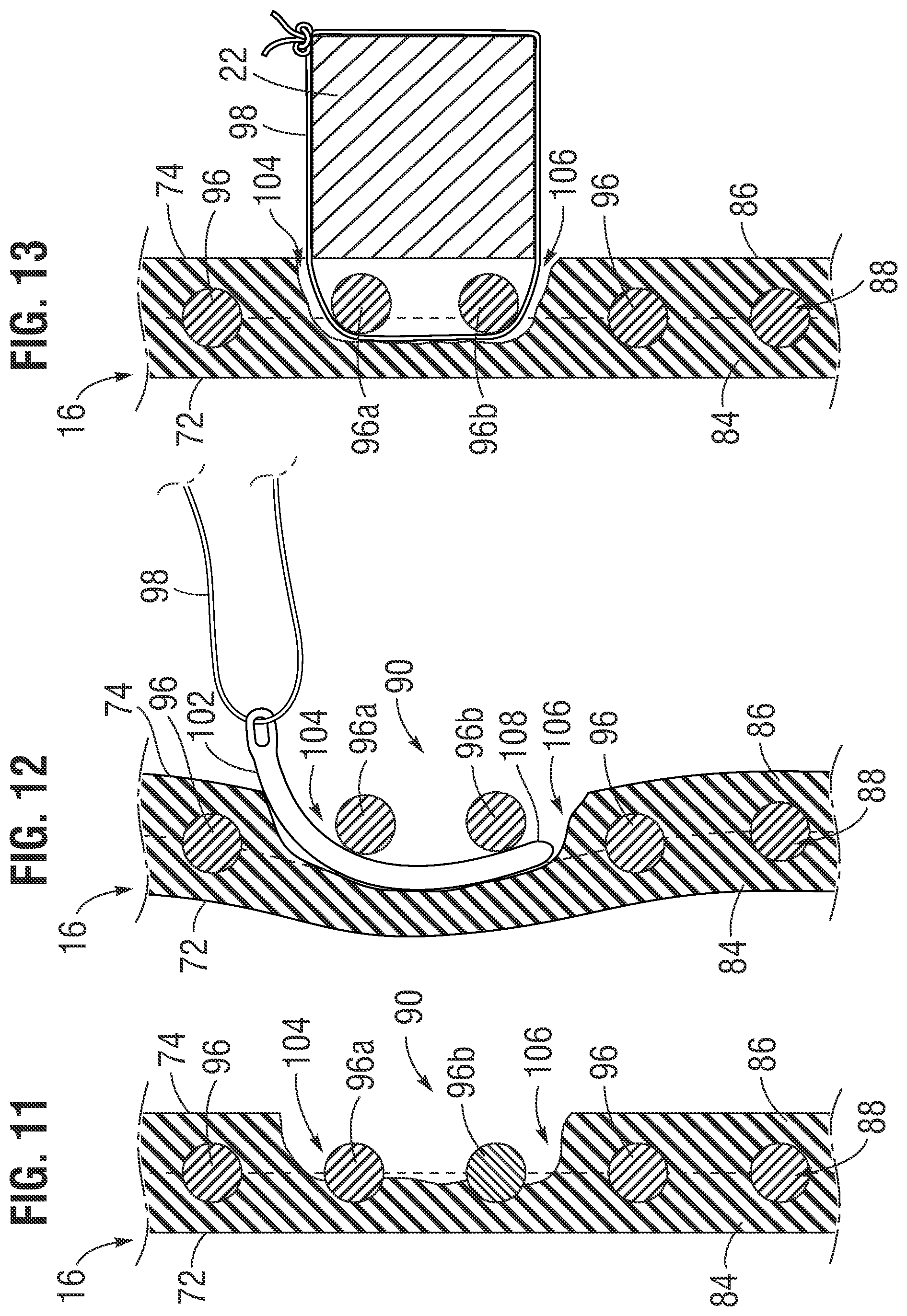 Patent US12472058 Figure 5 – Skirt assembly for implantable prosthetic valve
