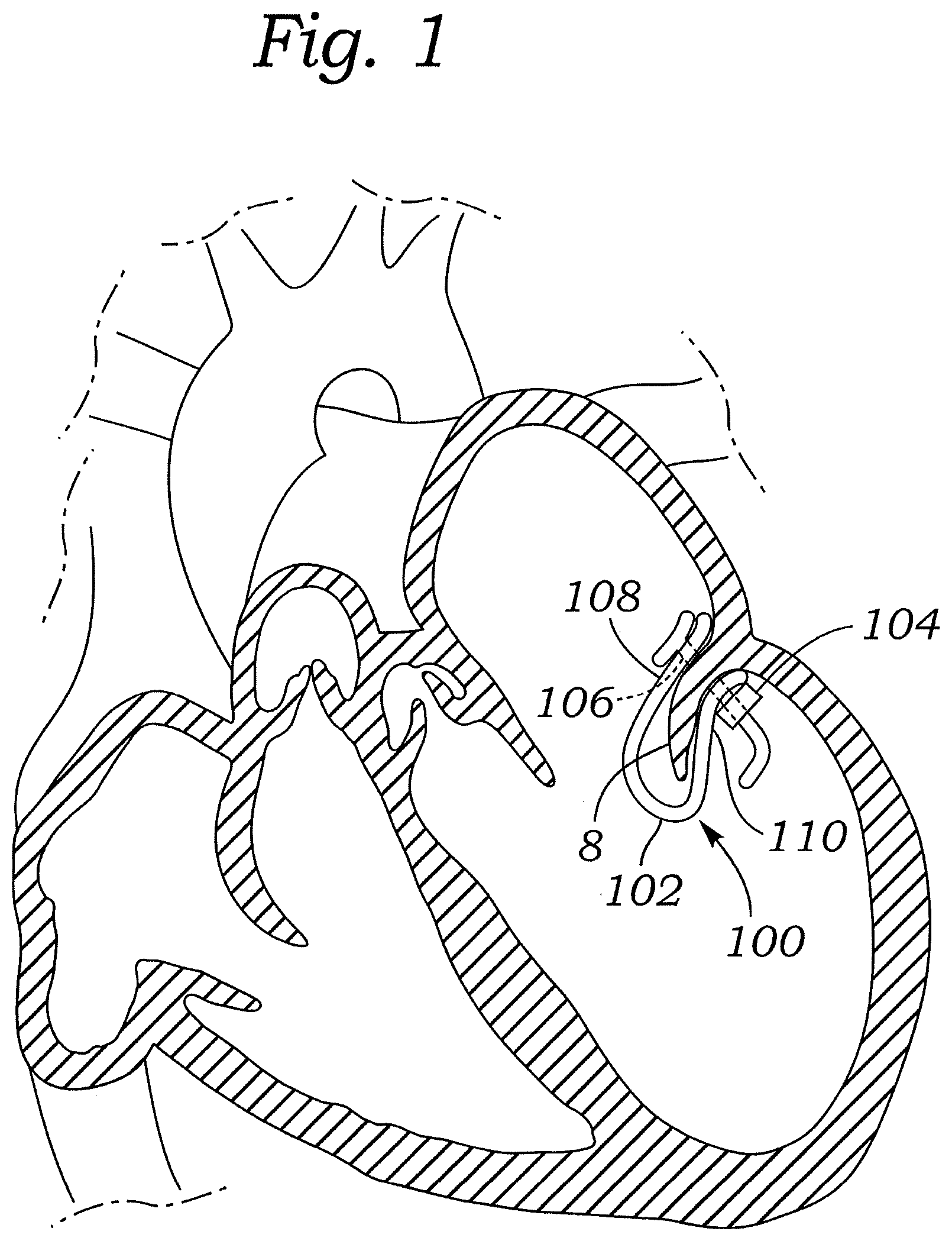 Patent US12472059 — Prosthetic heart valve docking assembly — Figure 1