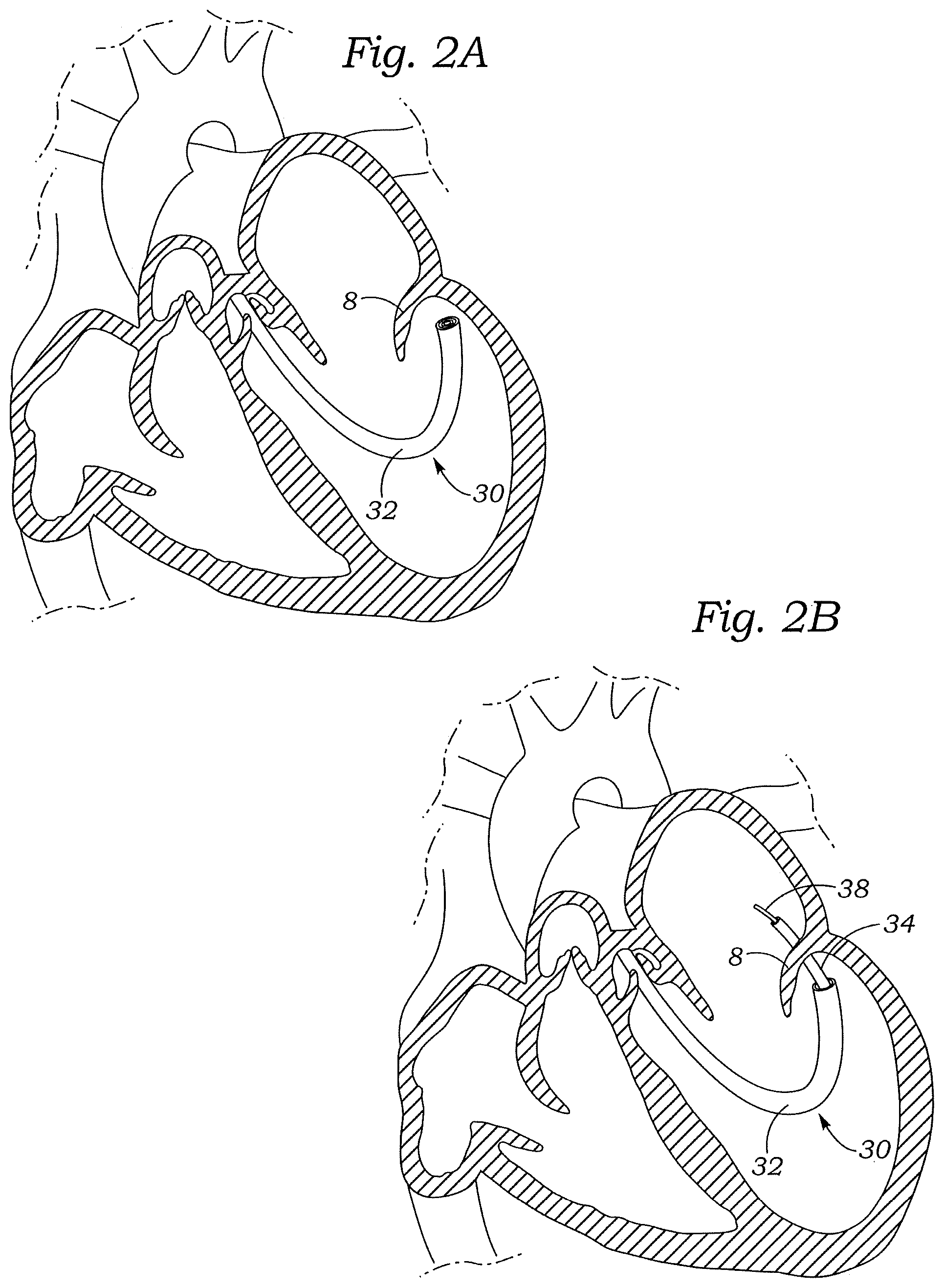 Patent US12472059 Figure 2 – Prosthetic heart valve docking assembly