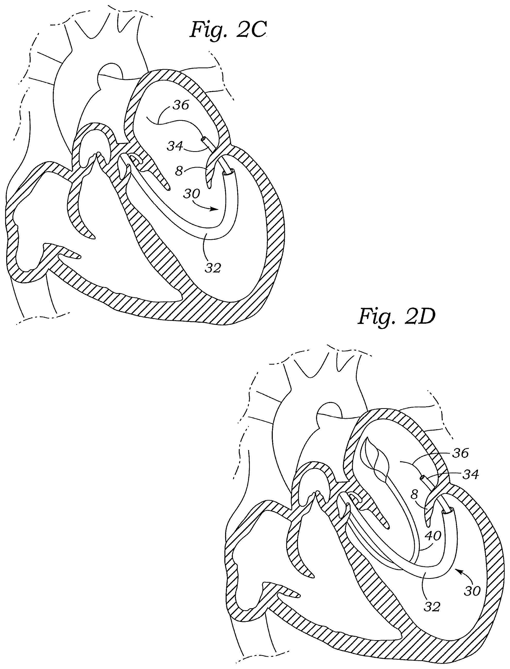 Patent US12472059 Figure 3 – Prosthetic heart valve docking assembly