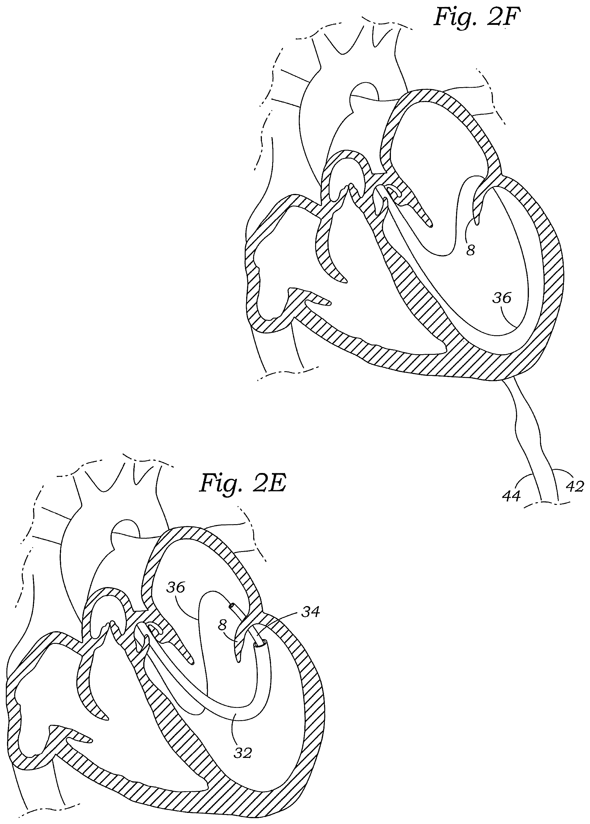 Patent US12472059 Figure 4 – Prosthetic heart valve docking assembly