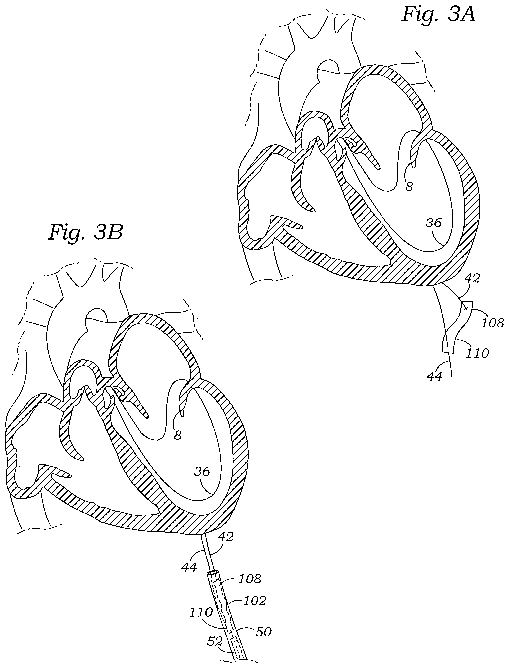 Patent US12472059 Figure 5 – Prosthetic heart valve docking assembly