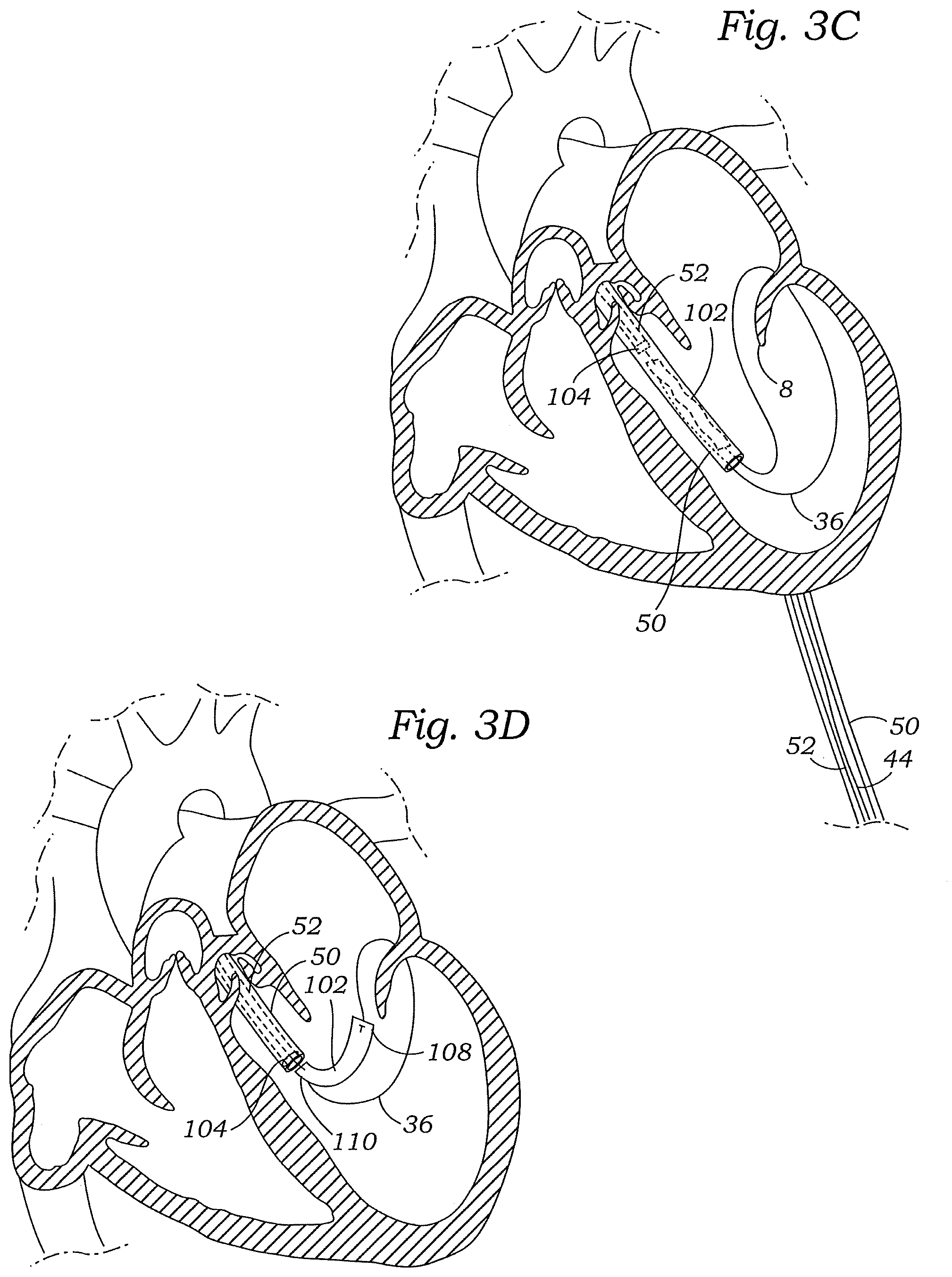 Patent US12472059 Figure 6 – Prosthetic heart valve docking assembly