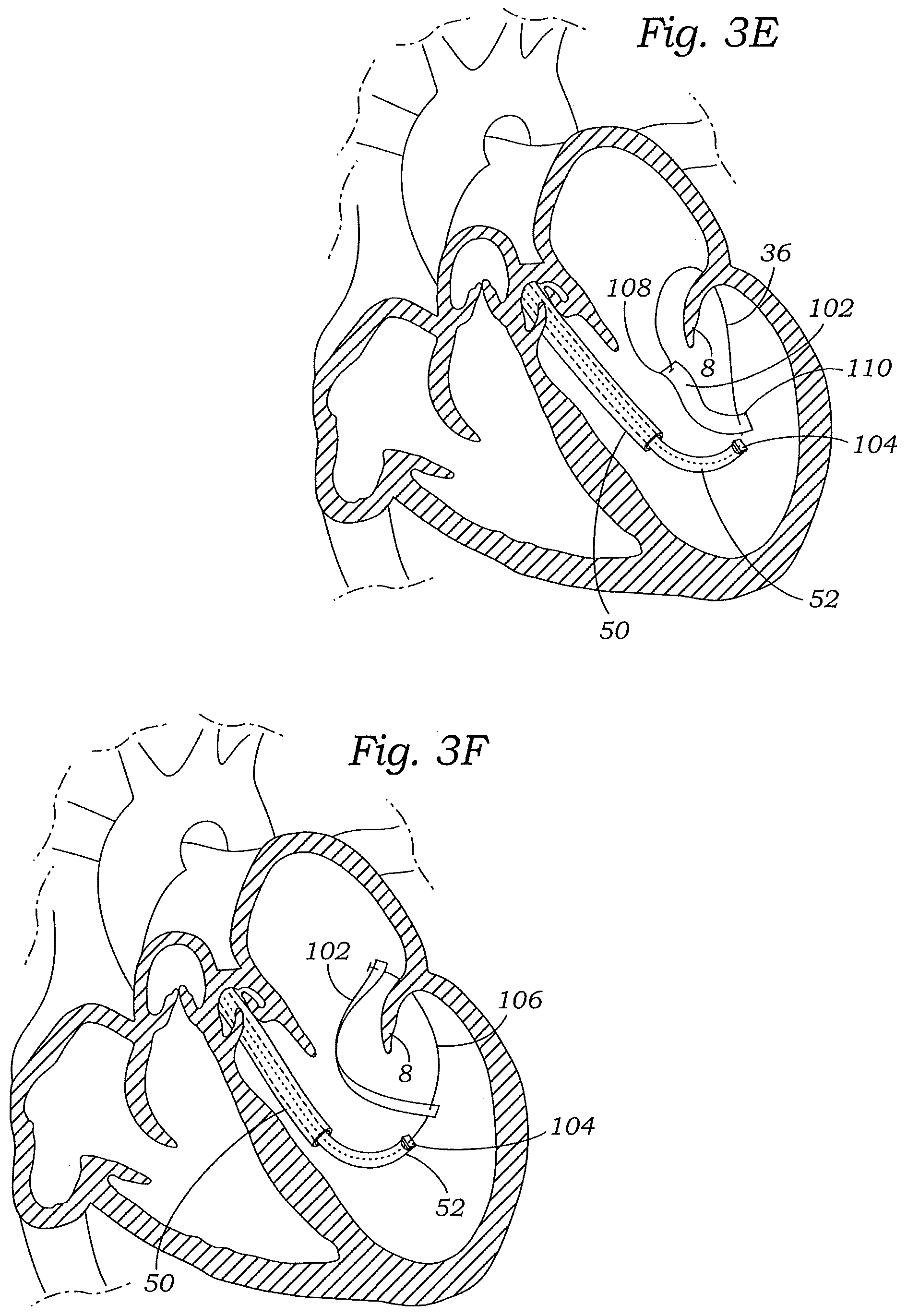 Patent US12472059 Figure 7 – Prosthetic heart valve docking assembly