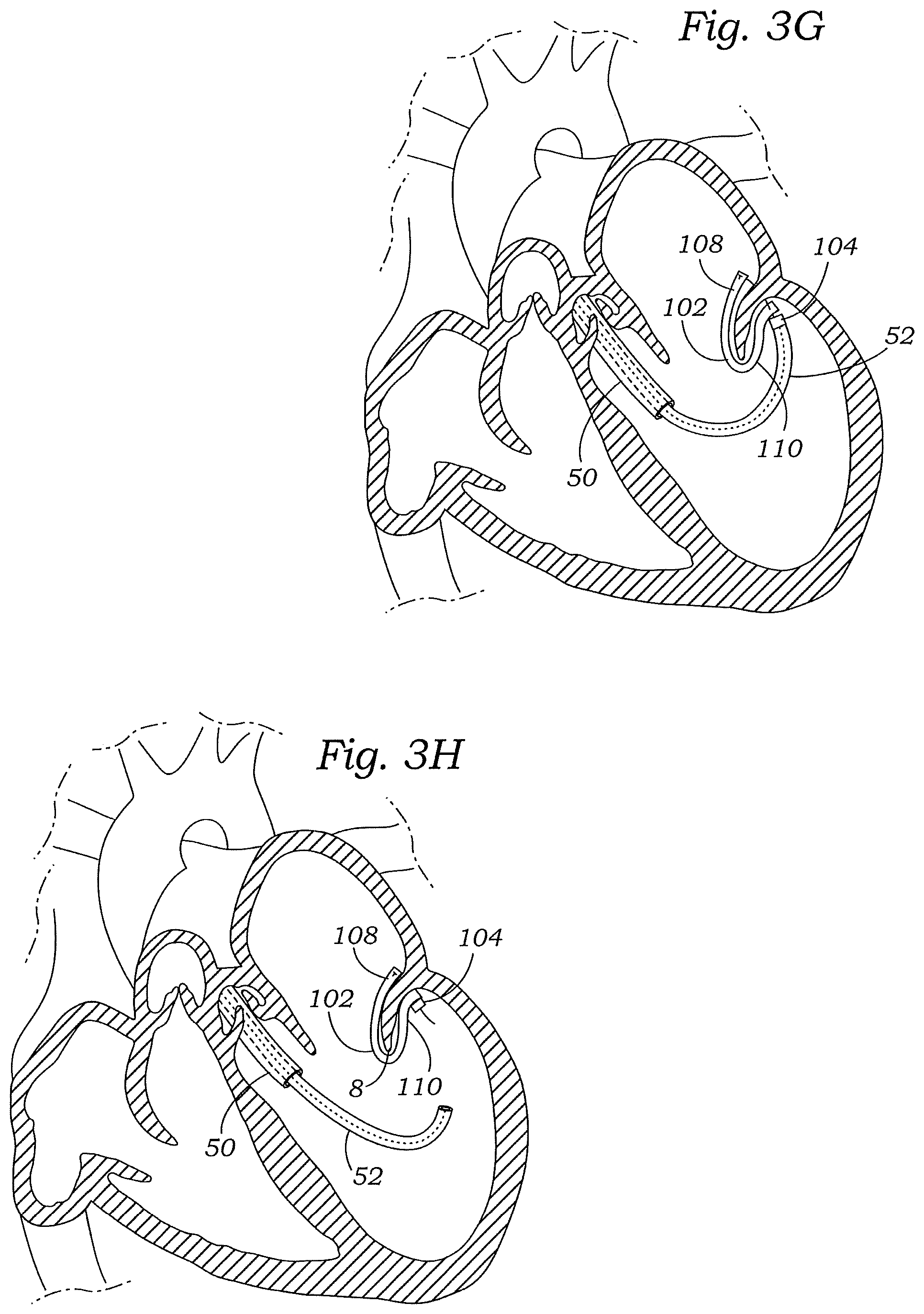 Patent US12472059 Figure 8 – Prosthetic heart valve docking assembly
