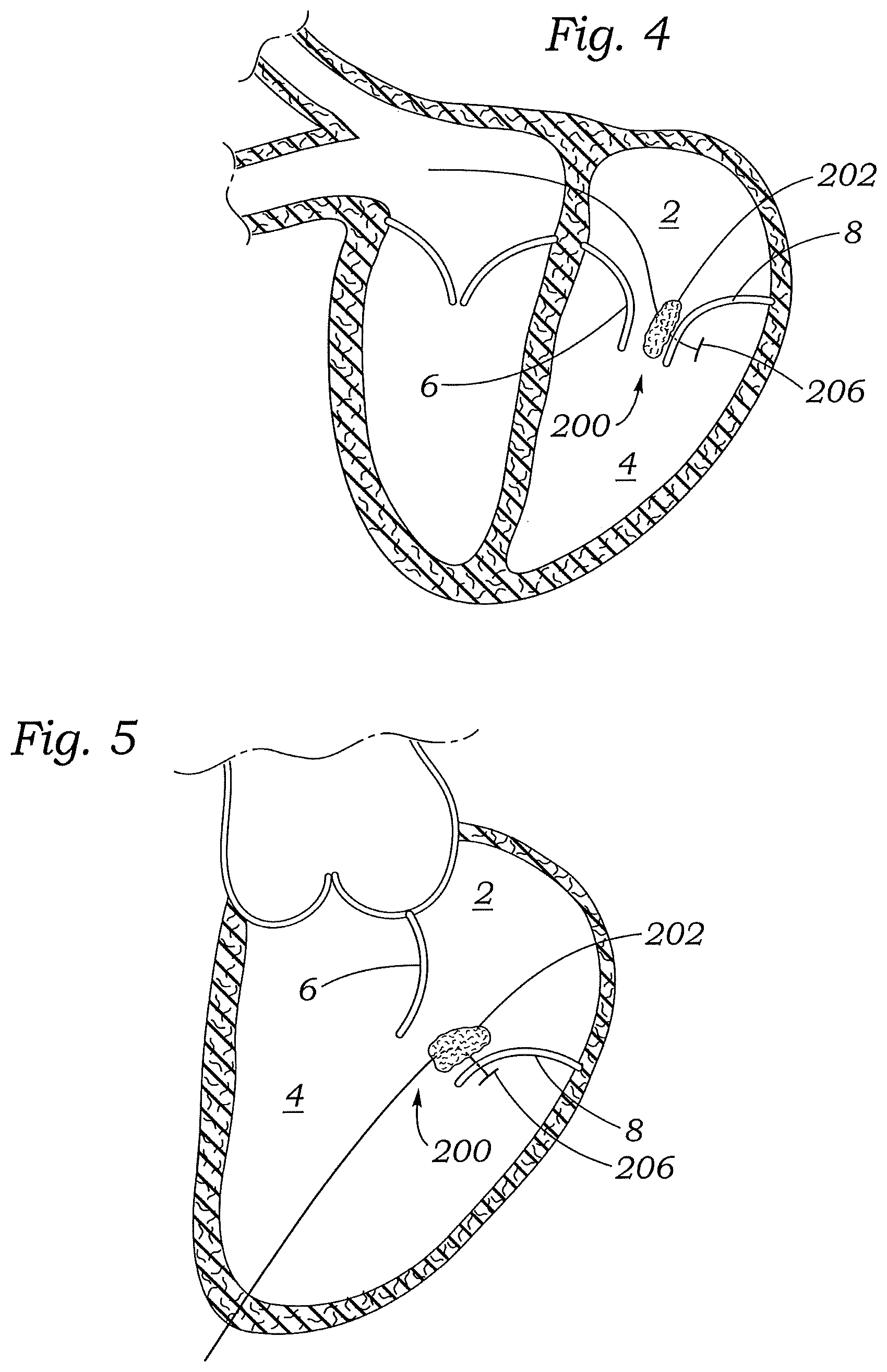 Patent US12472059 Figure 9 – Prosthetic heart valve docking assembly