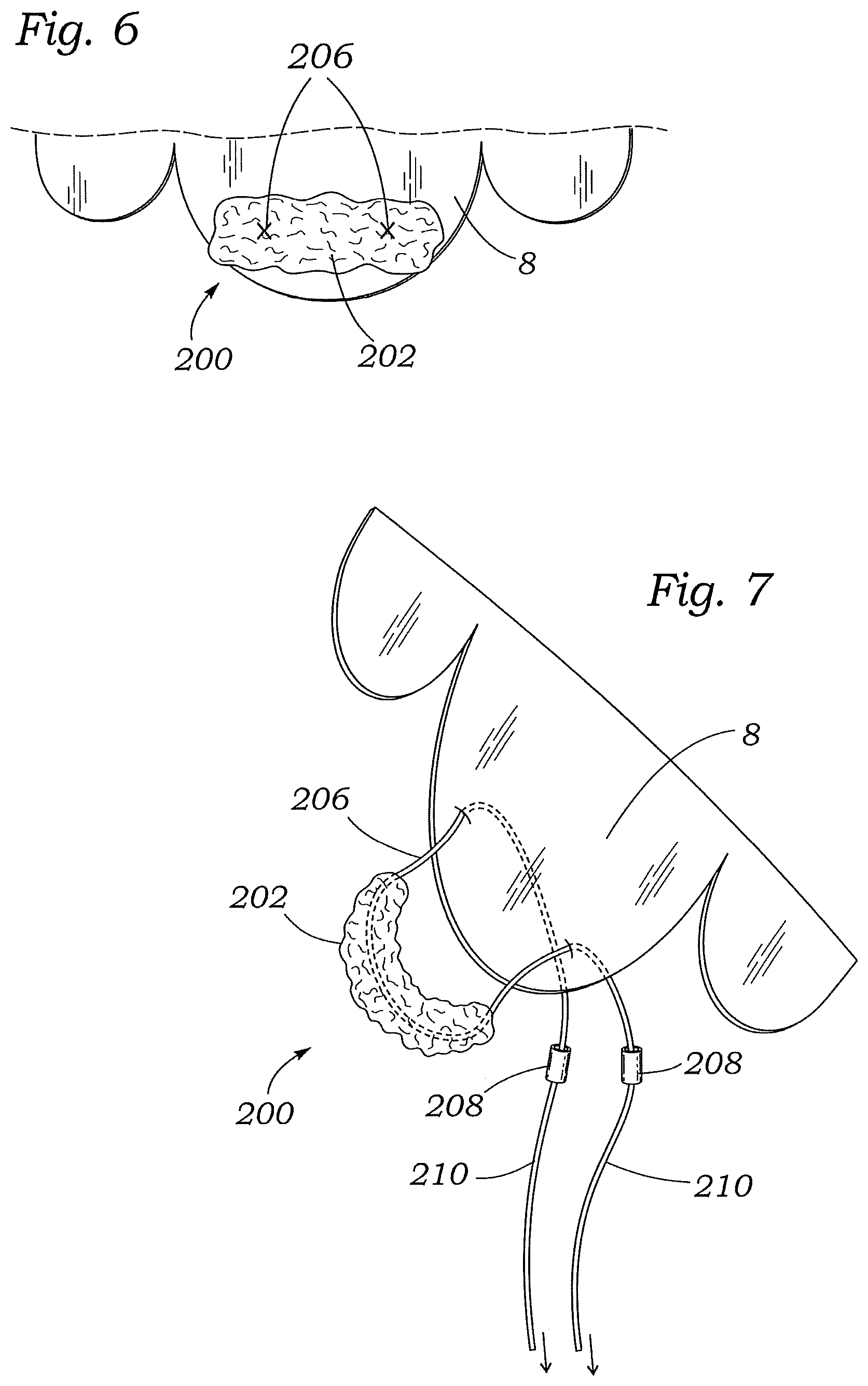 Patent US12472059 Figure 10 – Prosthetic heart valve docking assembly