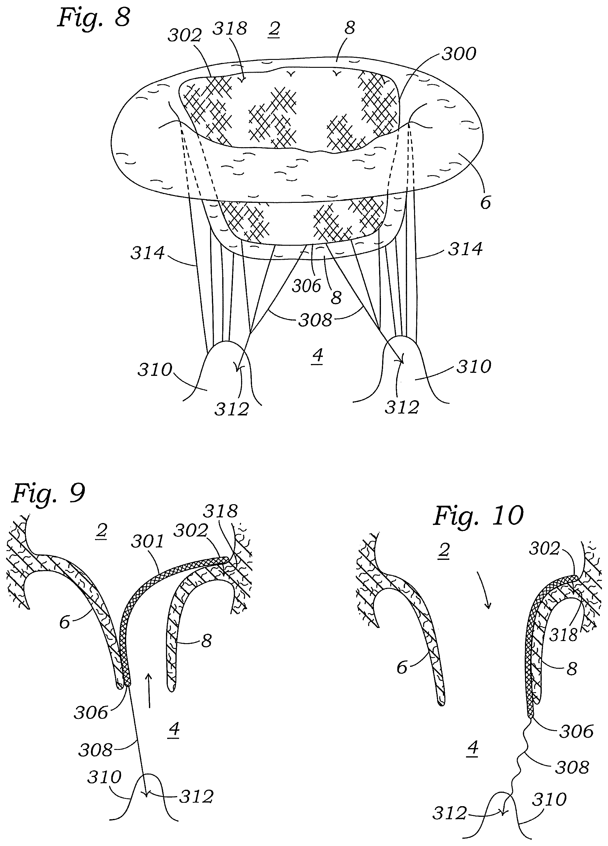 Patent US12472059 Figure 11 – Prosthetic heart valve docking assembly