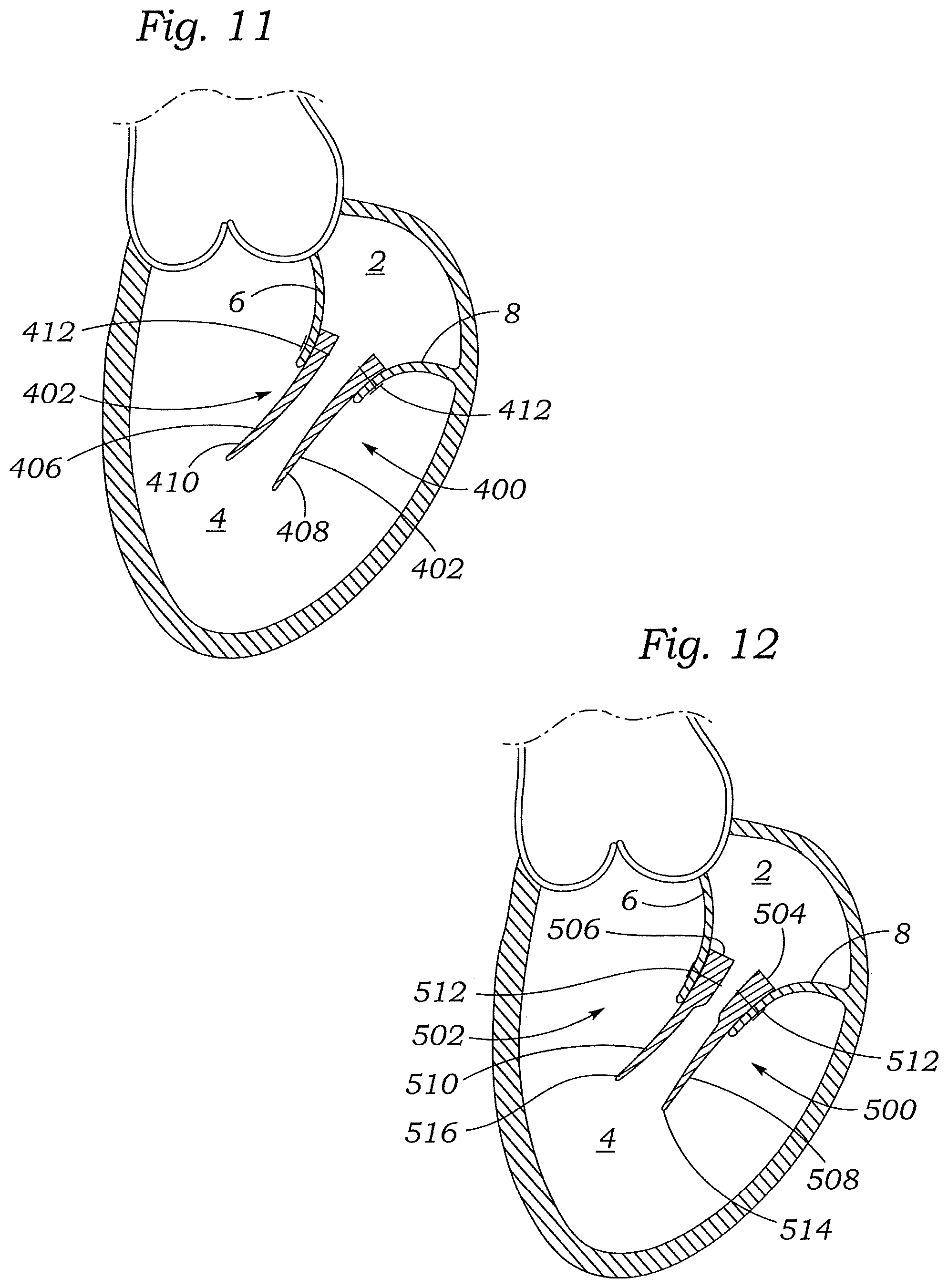Patent US12472059 Figure 12 – Prosthetic heart valve docking assembly