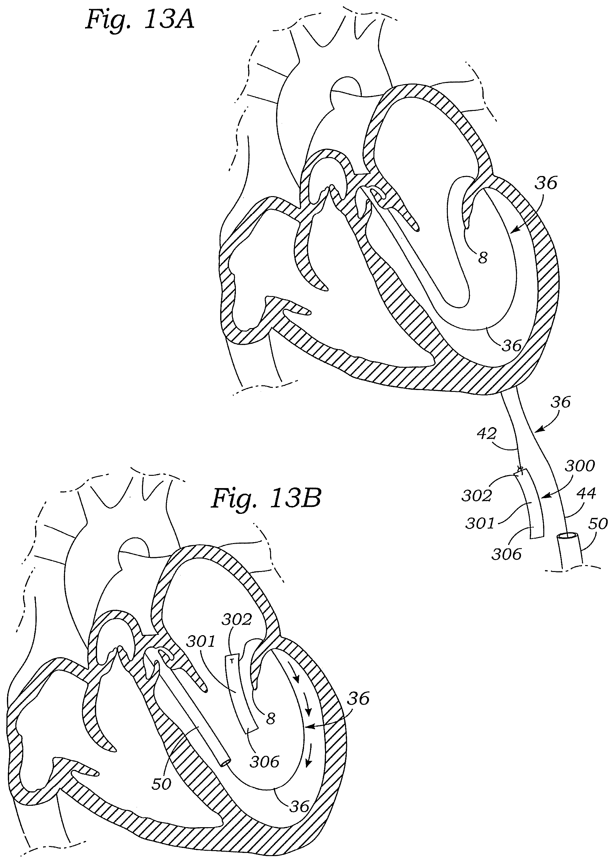 Patent US12472059 Figure 13 – Prosthetic heart valve docking assembly