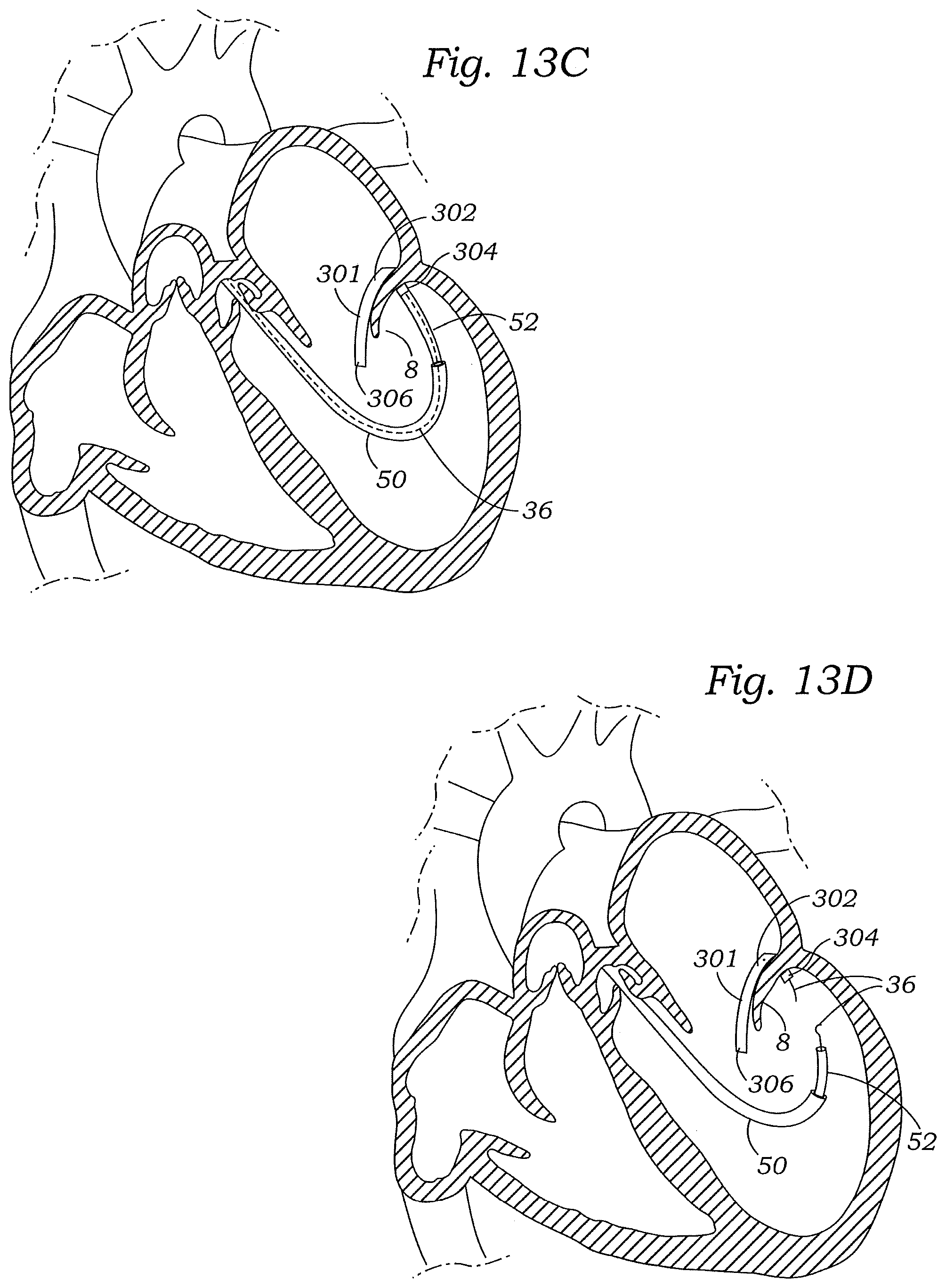Patent US12472059 Figure 14 – Prosthetic heart valve docking assembly