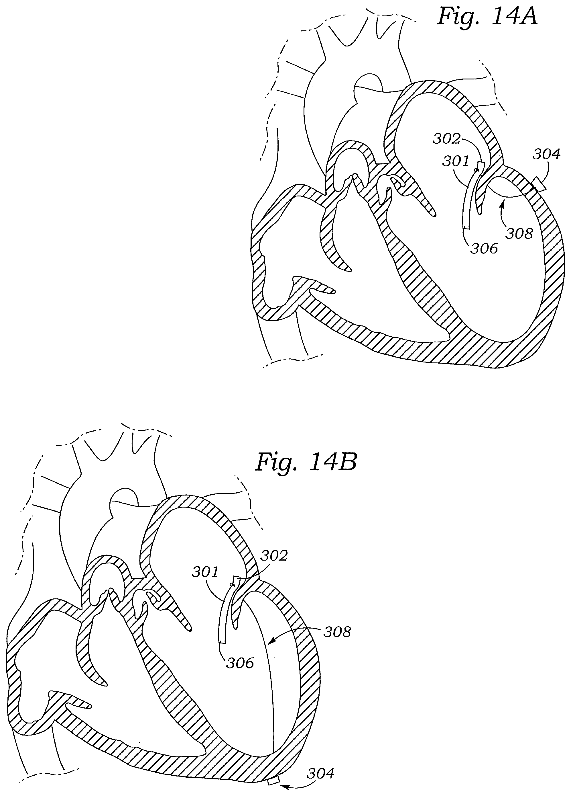 Patent US12472059 Figure 15 – Prosthetic heart valve docking assembly