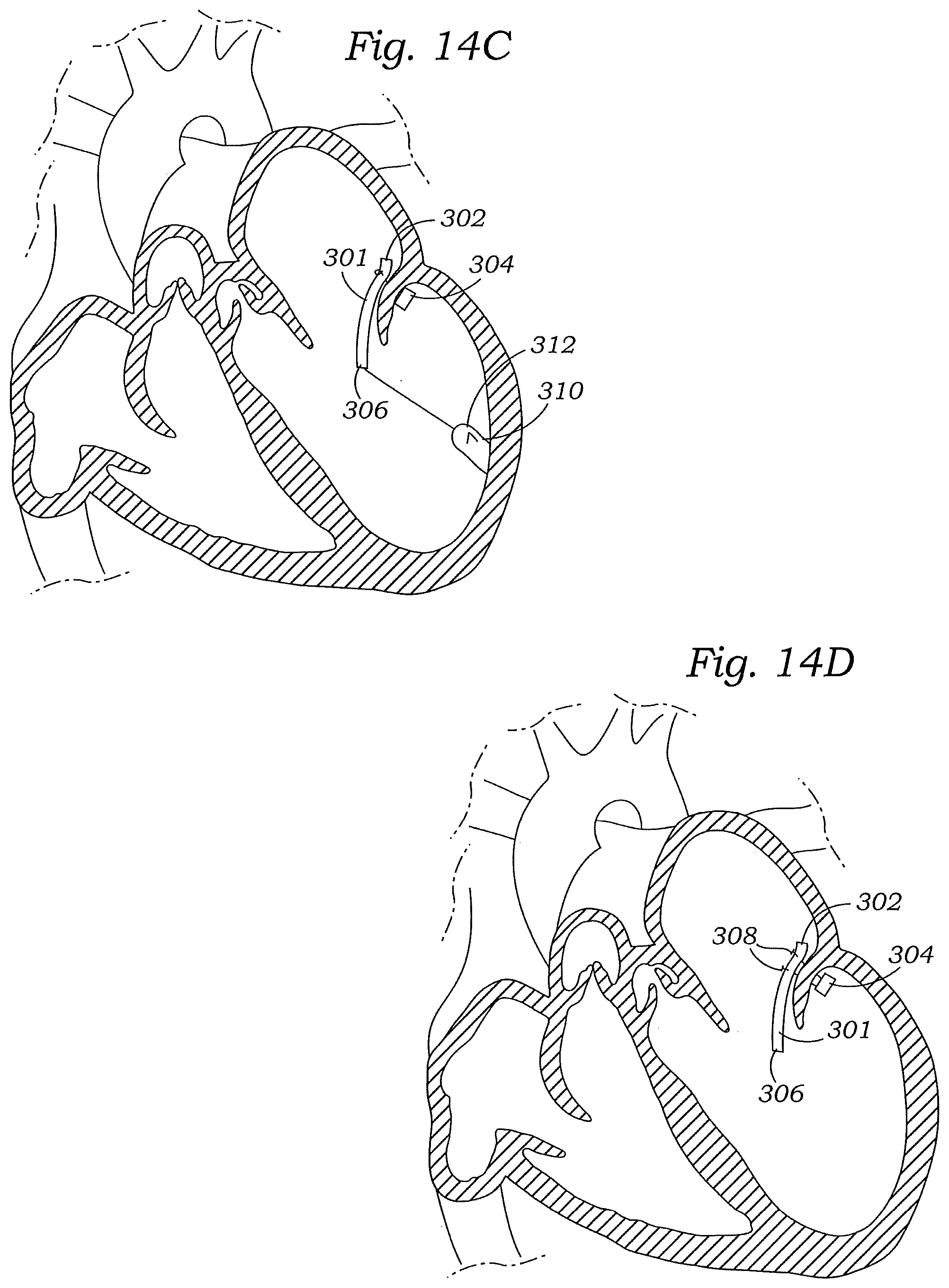 Patent US12472059 Figure 16 – Prosthetic heart valve docking assembly