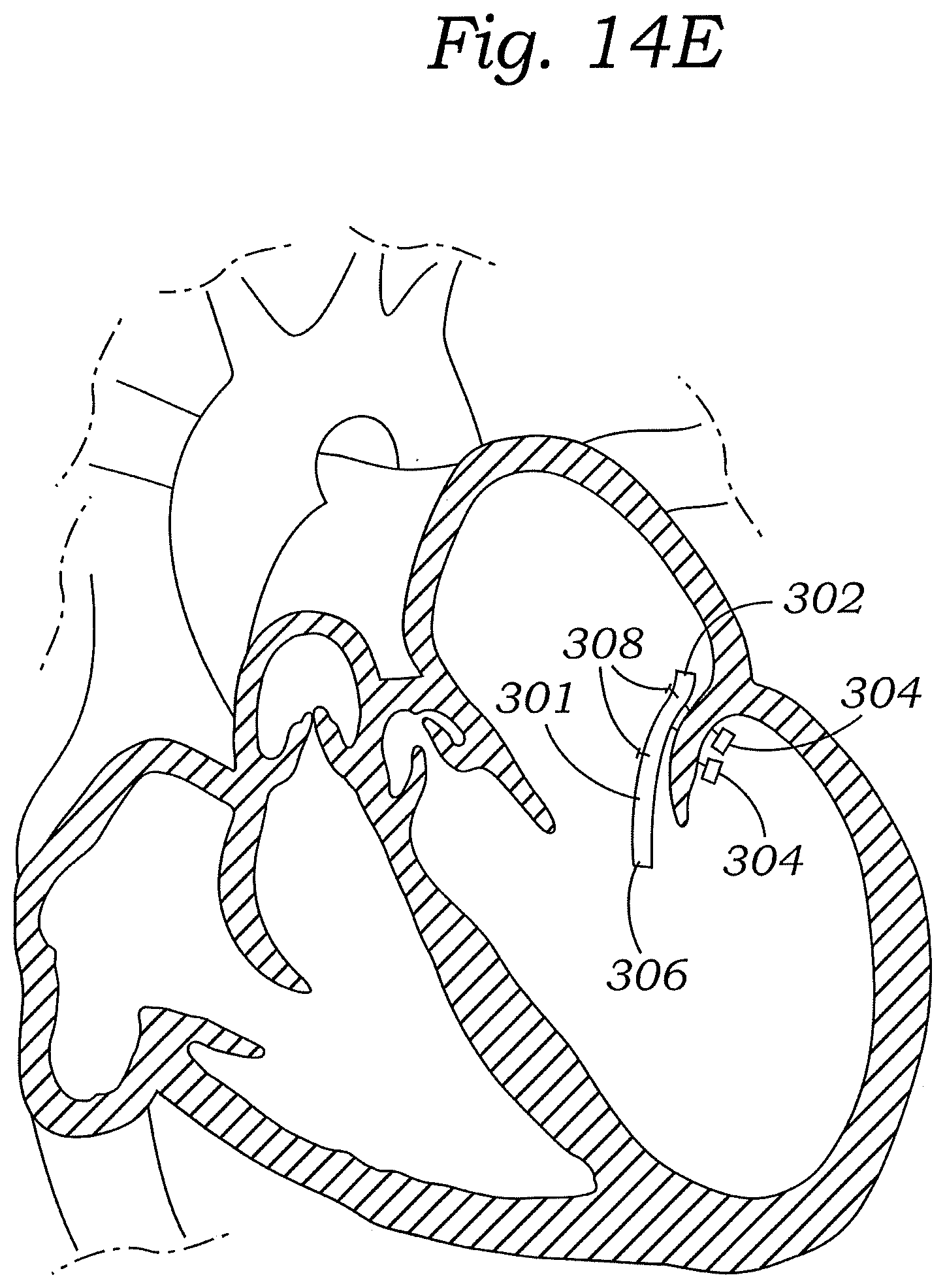 Patent US12472059 Figure 17 – Prosthetic heart valve docking assembly