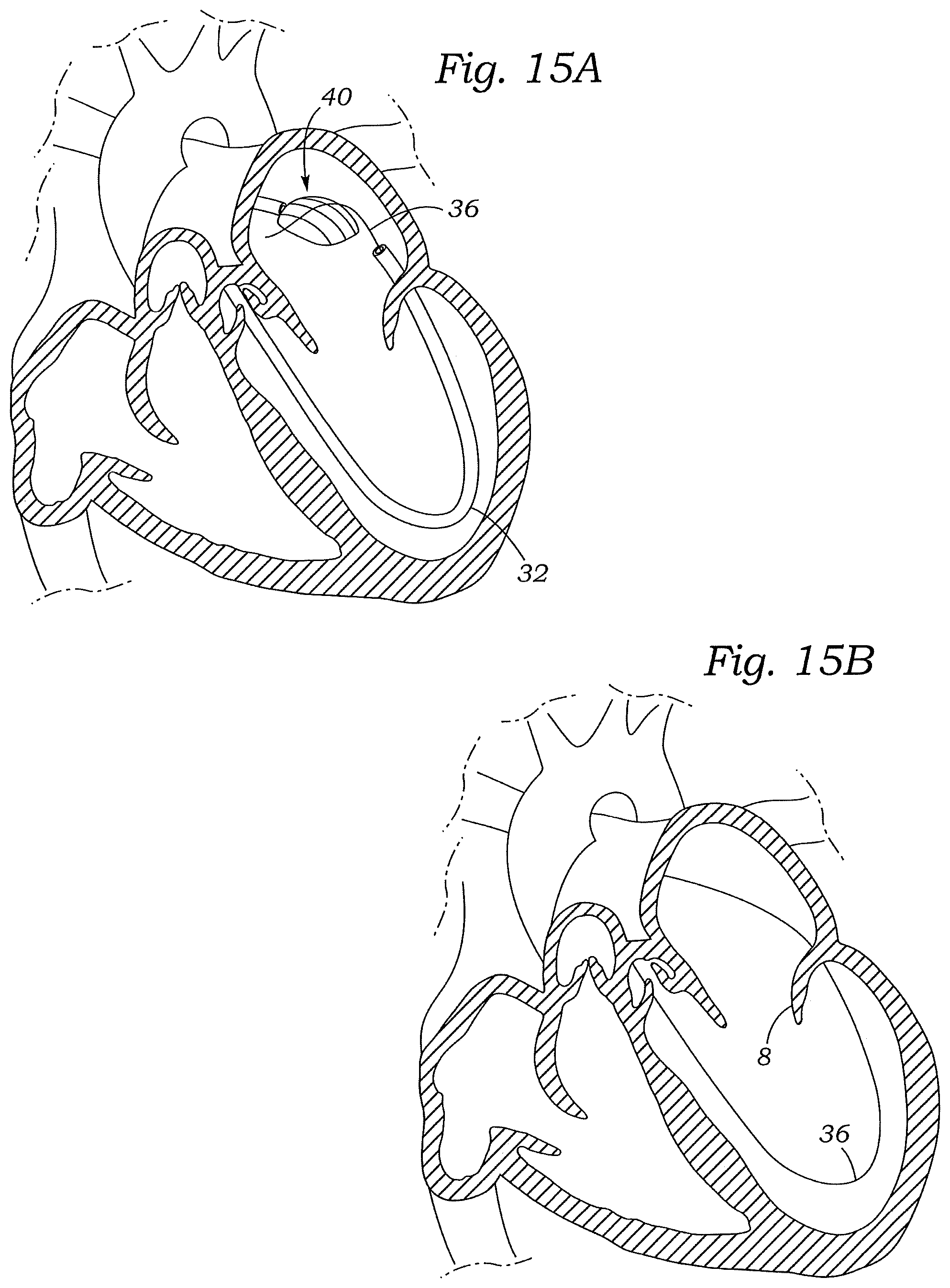 Patent US12472059 Figure 18 – Prosthetic heart valve docking assembly