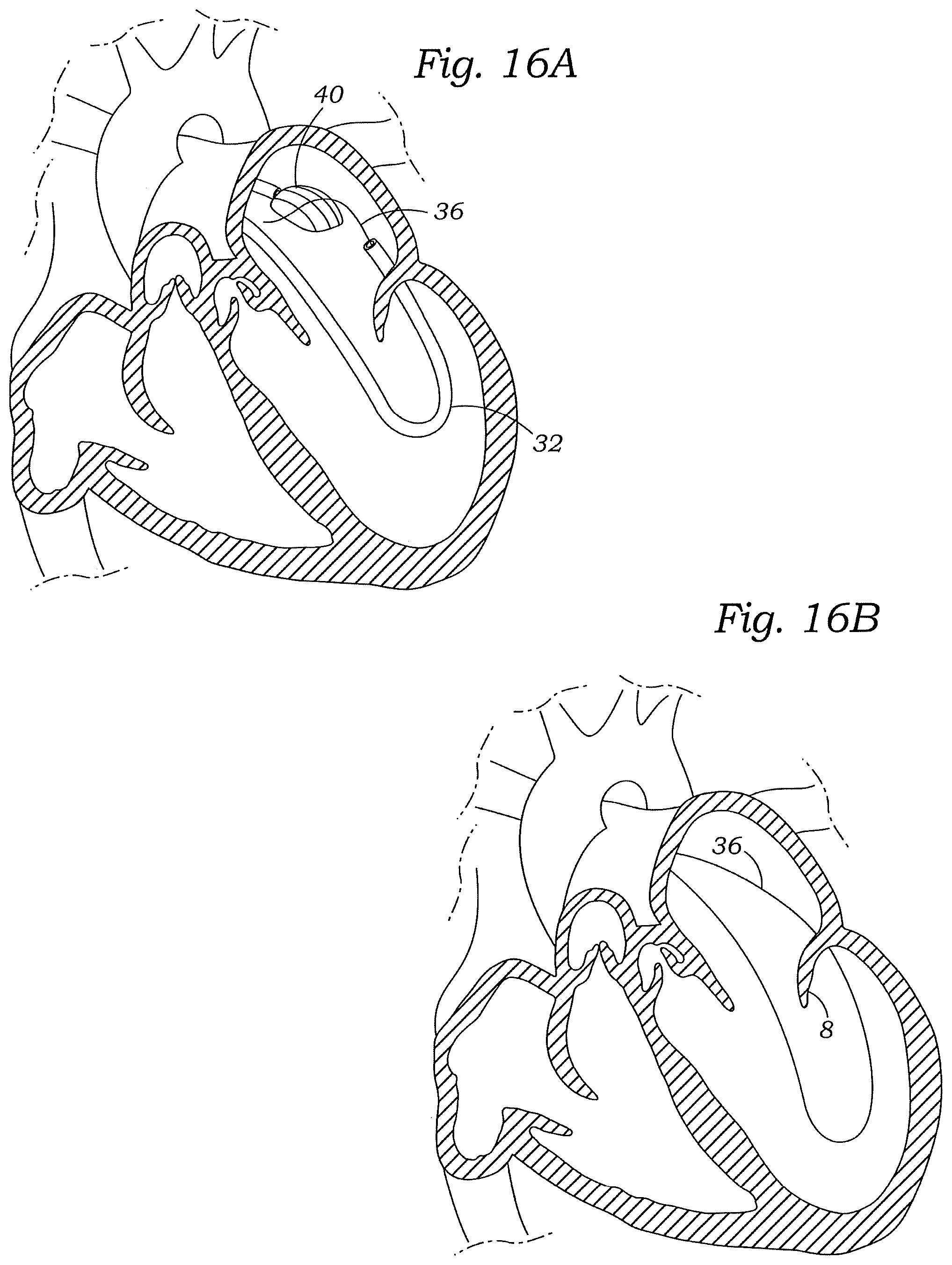 Patent US12472059 Figure 19 – Prosthetic heart valve docking assembly