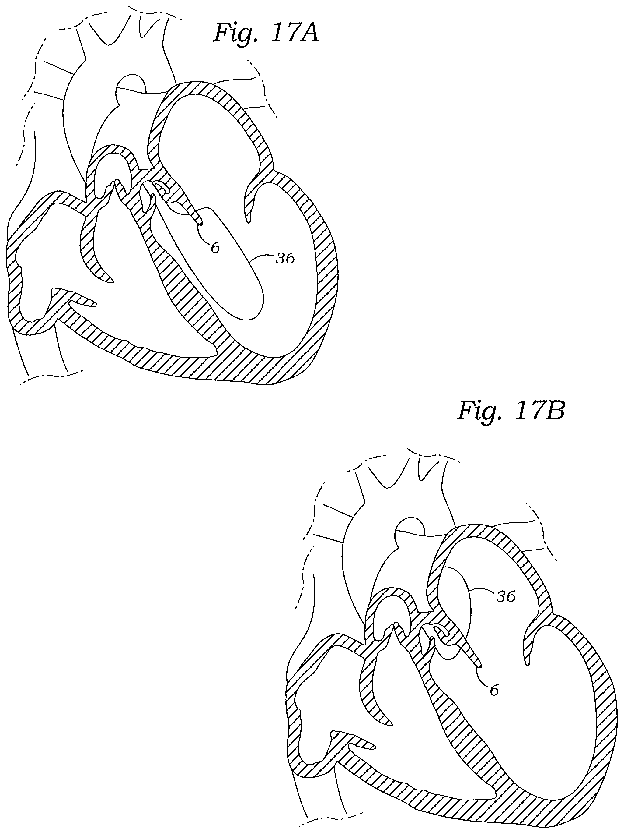 Patent US12472059 Figure 20 – Prosthetic heart valve docking assembly
