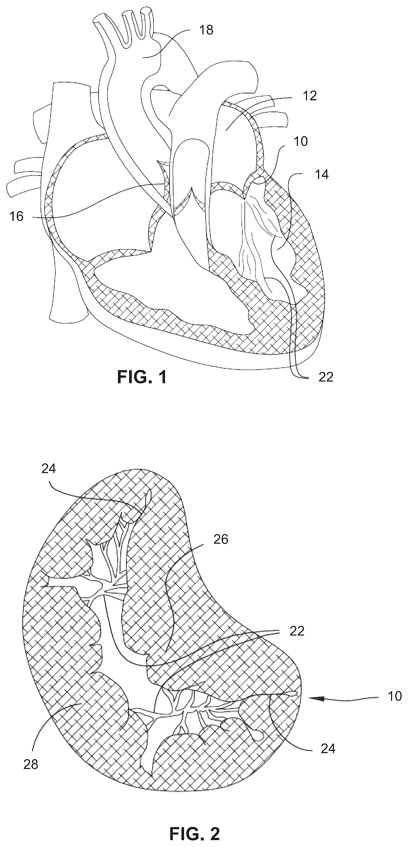 Patent US12472061 Figure 1 – Systems, devices, and methods for treating heart valves