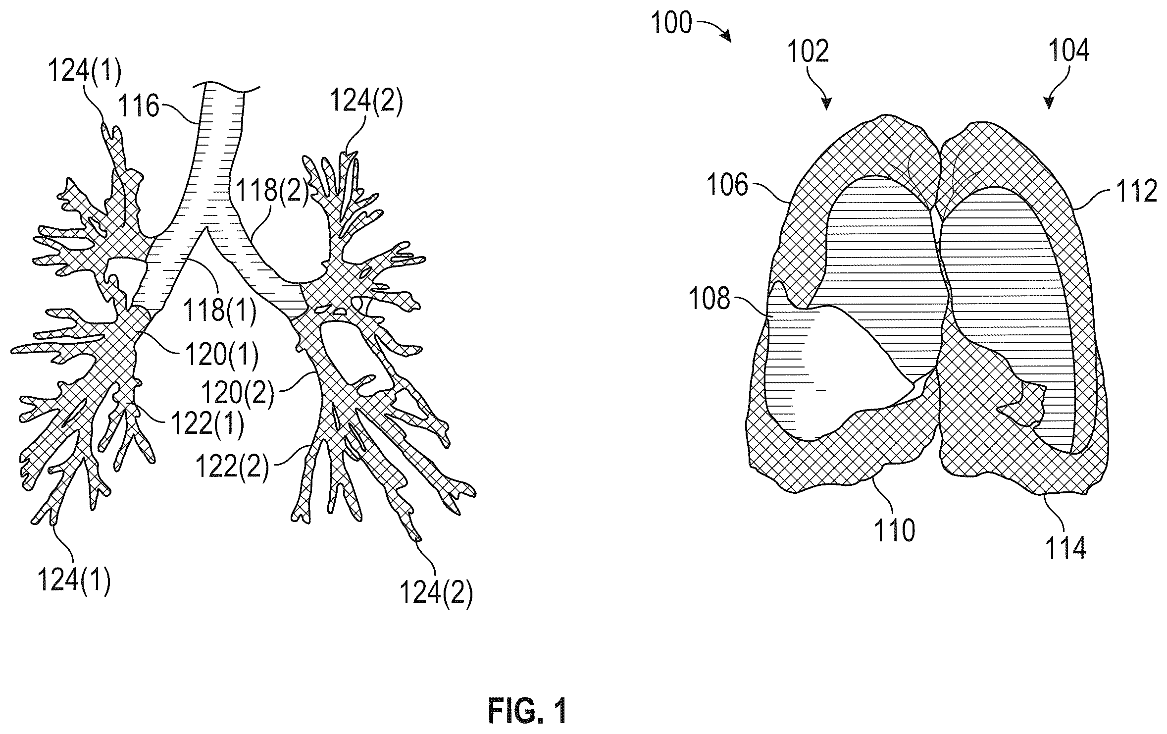 Patent US12472063 Figure 1 – Method and apparatus for treating hyperinflation and associated complications in lung regions