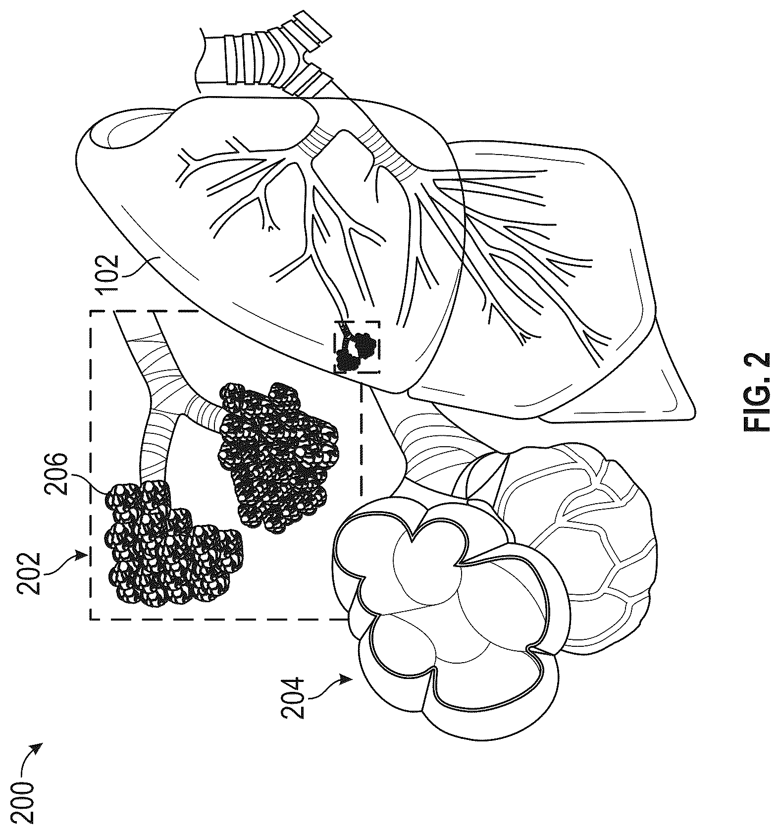 Patent US12472063 Figure 2 – Method and apparatus for treating hyperinflation and associated complications in lung regions