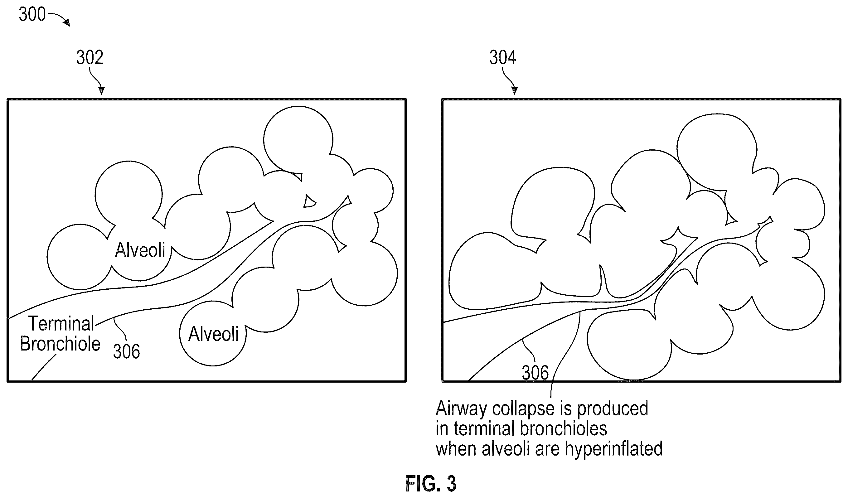 Patent US12472063 Figure 3 – Method and apparatus for treating hyperinflation and associated complications in lung regions