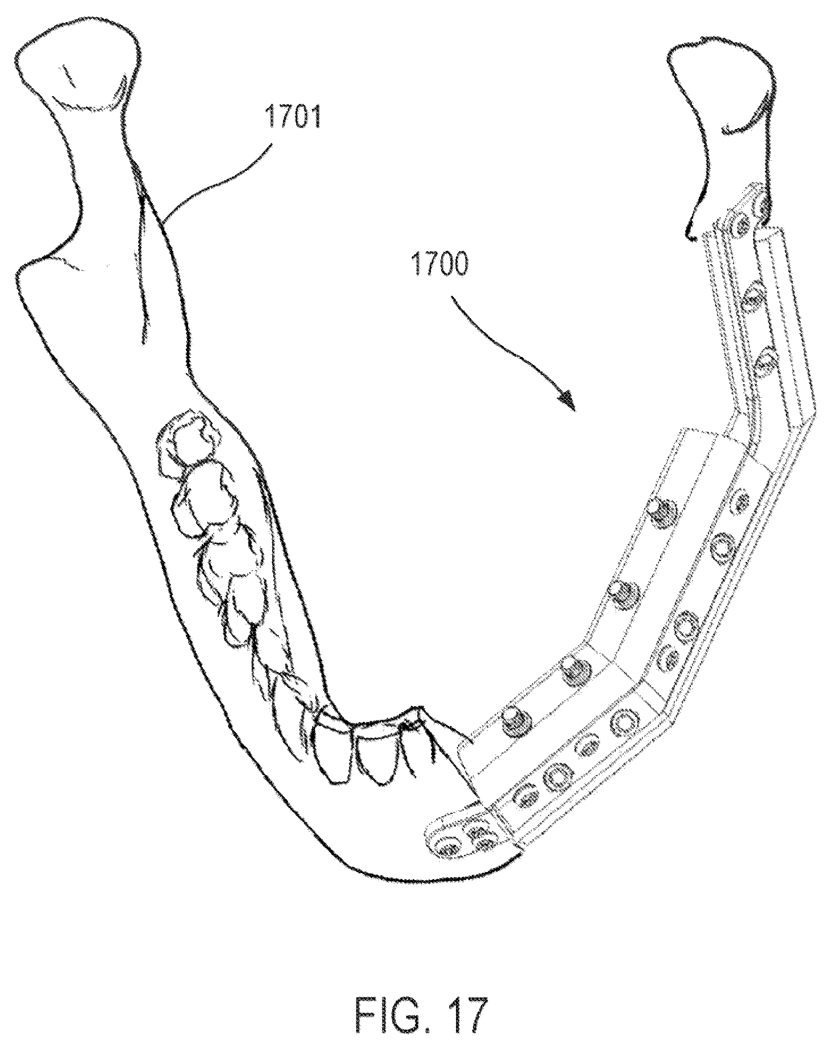 Patent US12472064 Figure 19 – Mandibular reconstruction systems and methods