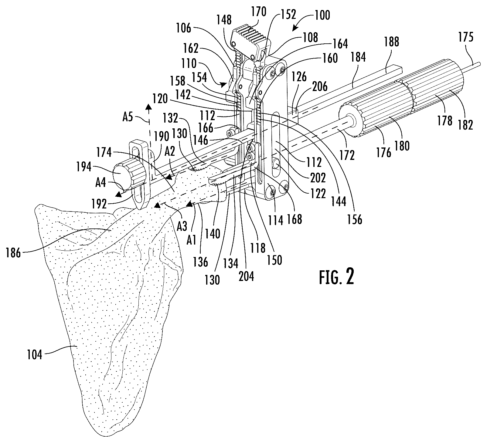 Patent US12472065 Figure 2 – Systems and methods of shoulder implant surgical guide