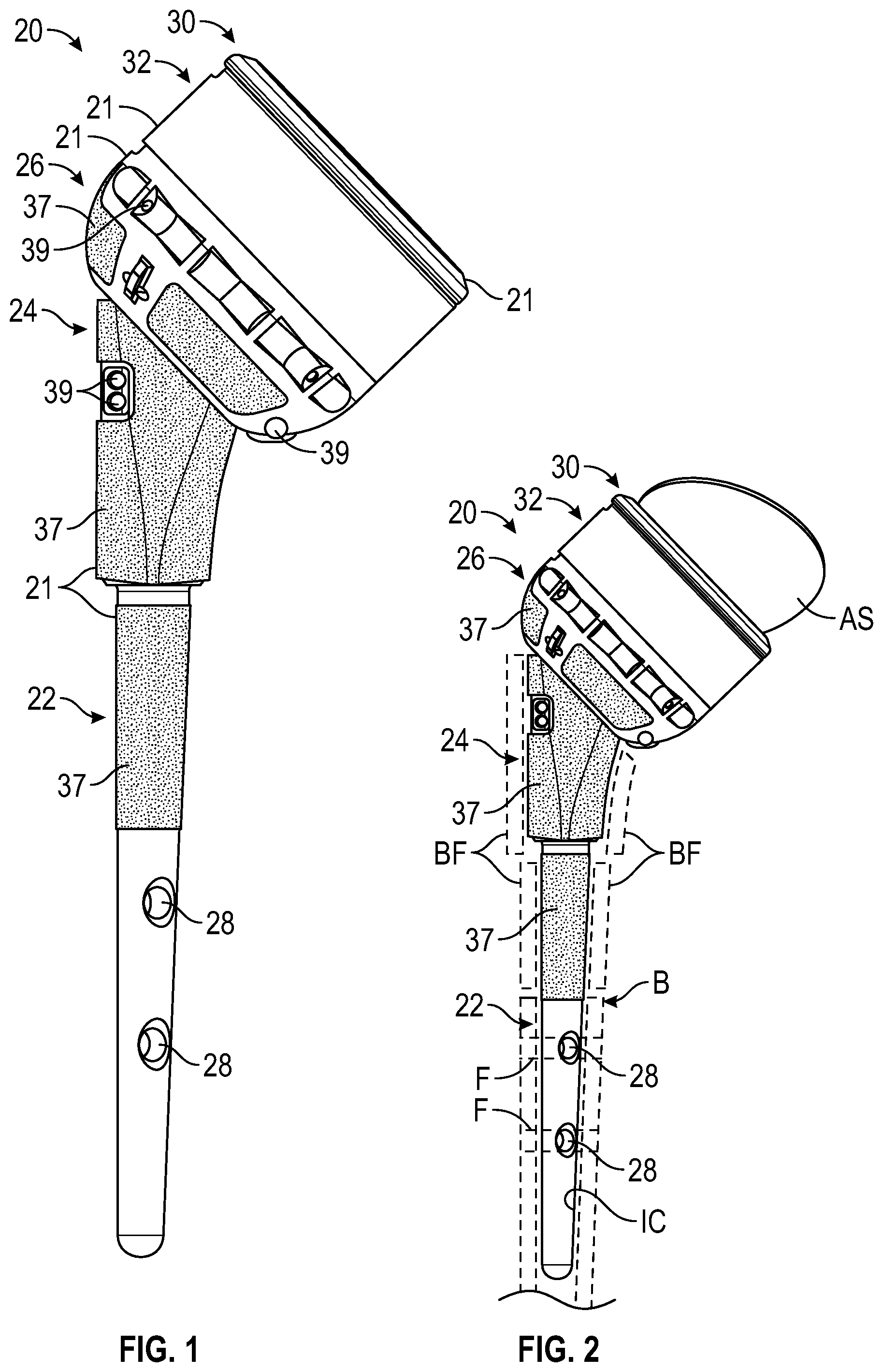 Patent US12472067 Figure 1 – Orthopaedic implant systems including fixation features and methods of repair