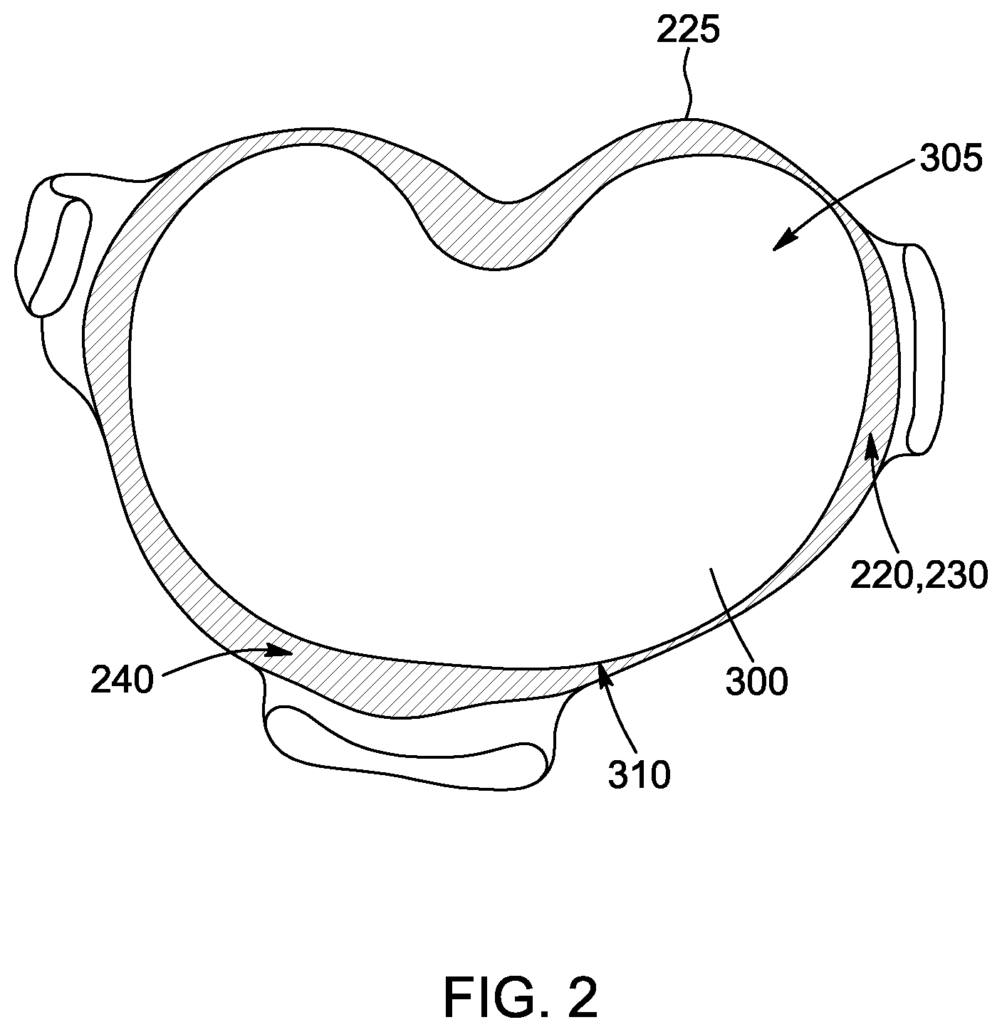 Patent US12472068 Figure 2 – Method for designing a patient-specific implant and patient-specific implant
